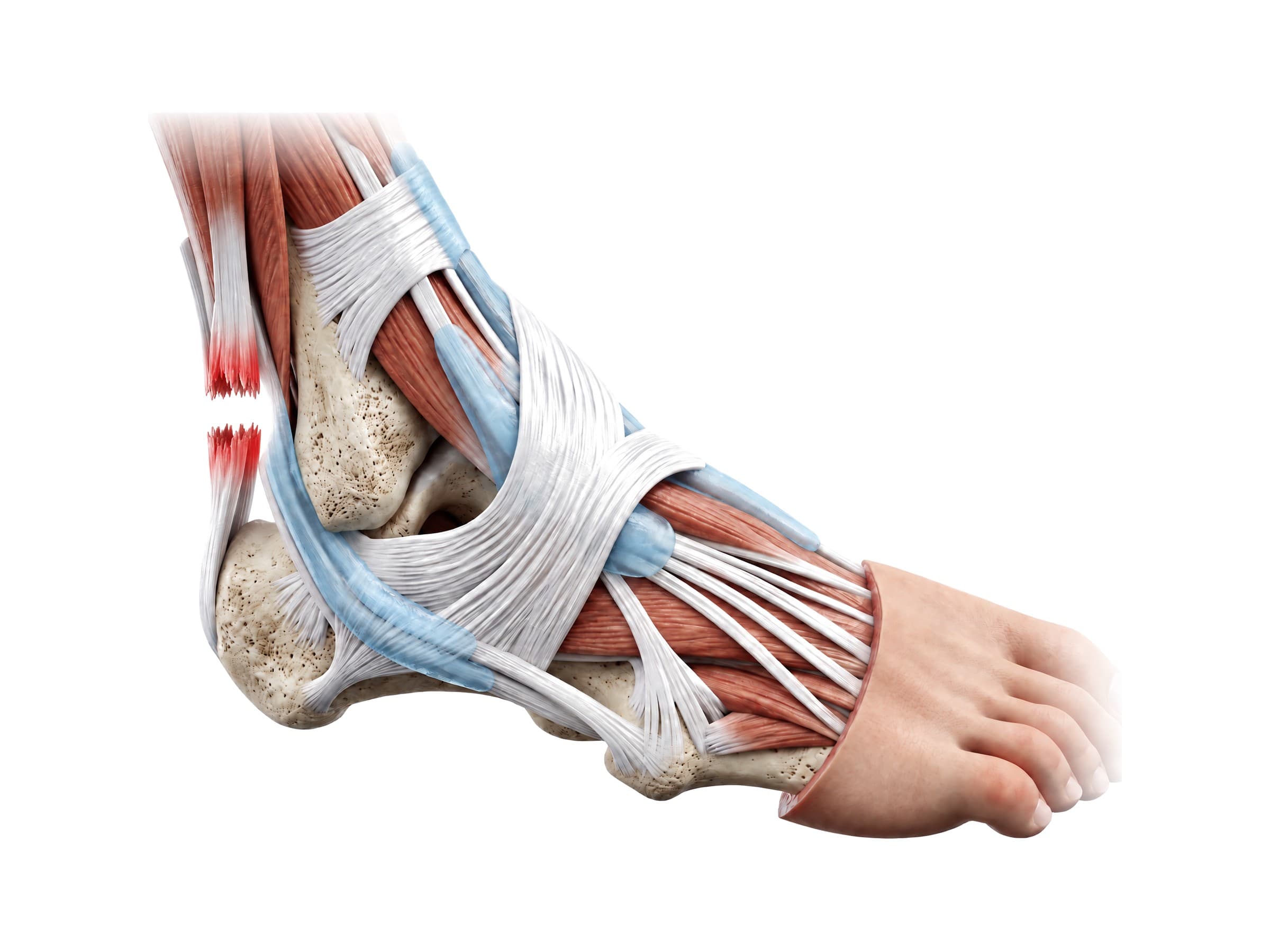 Achilles tendon rupture above the heel bone, highlighted in red (right ankle)