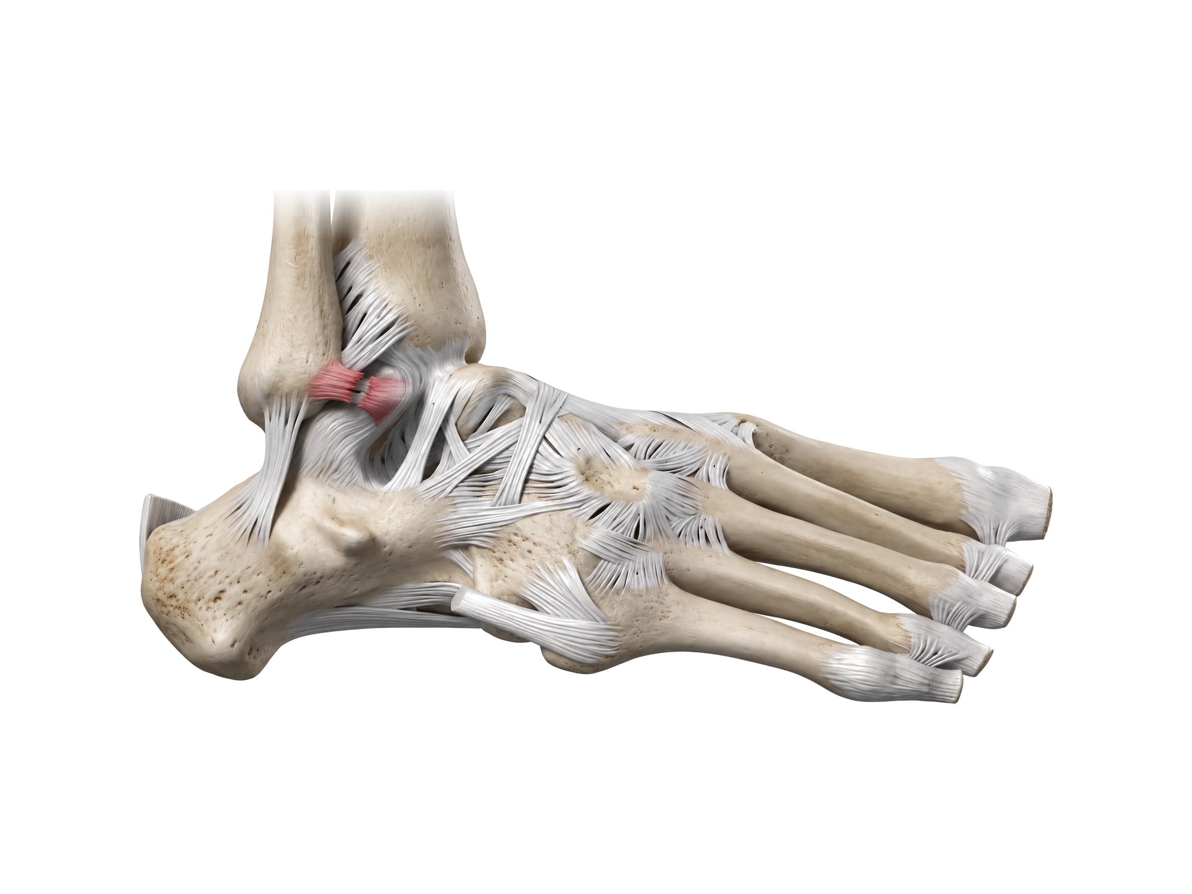 Ankle sprain: torn anterior talofibular ligament (ATFL), highlighted in red (right ankle)