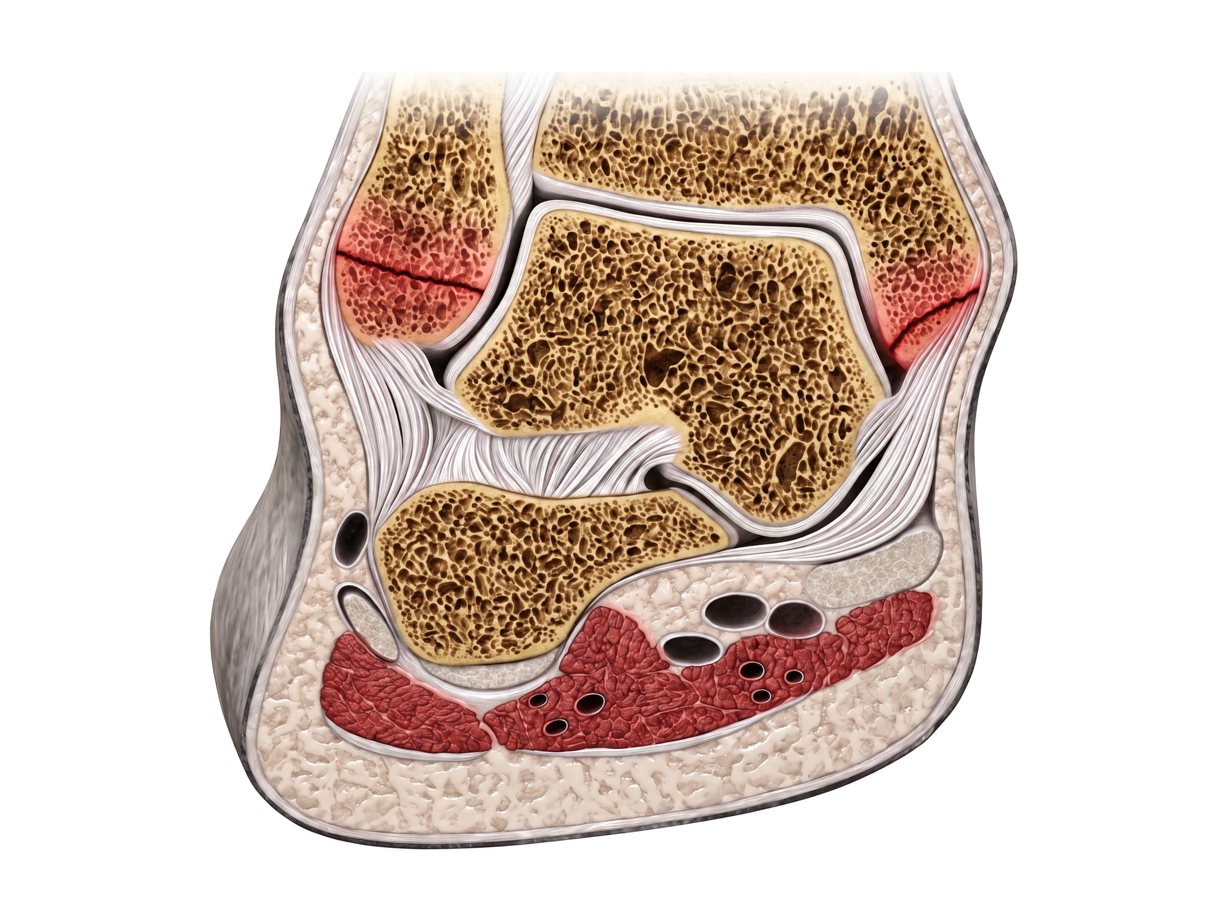 Bimalleolar ankle fracture through the lateral and medial malleolus, highlighted in red