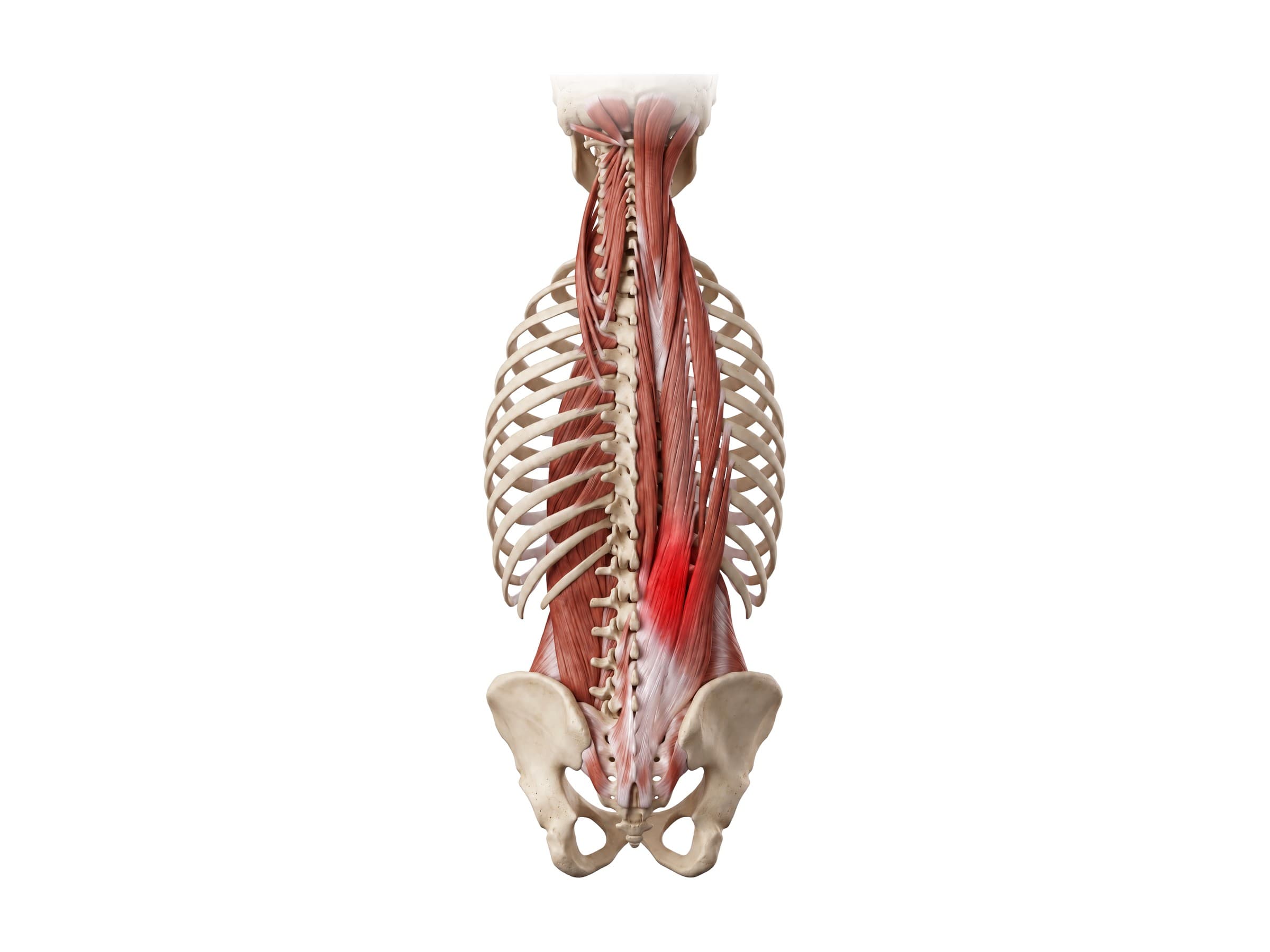 Lumbar muscle strain of the erector spinae, highlighted in red (back view)