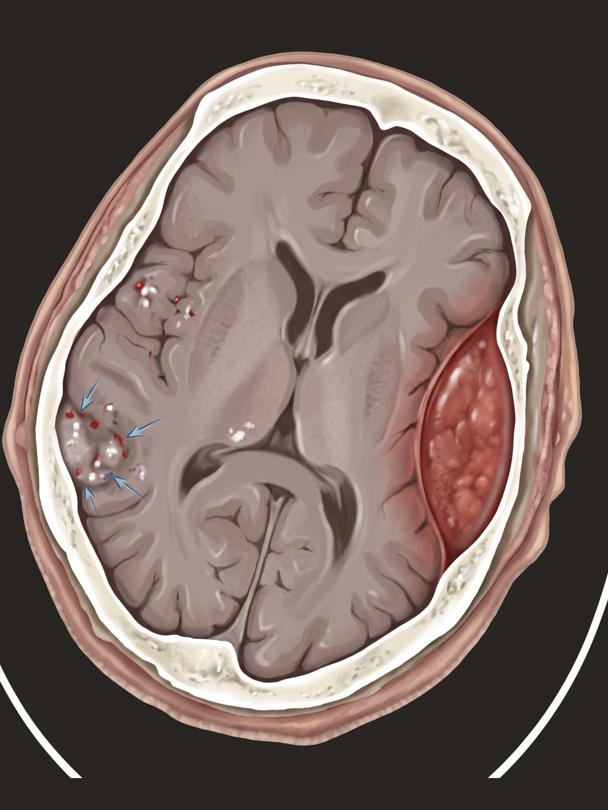 Epidural hematoma illustration traced from the same CT slice: lens-shaped clot pressing on the brain