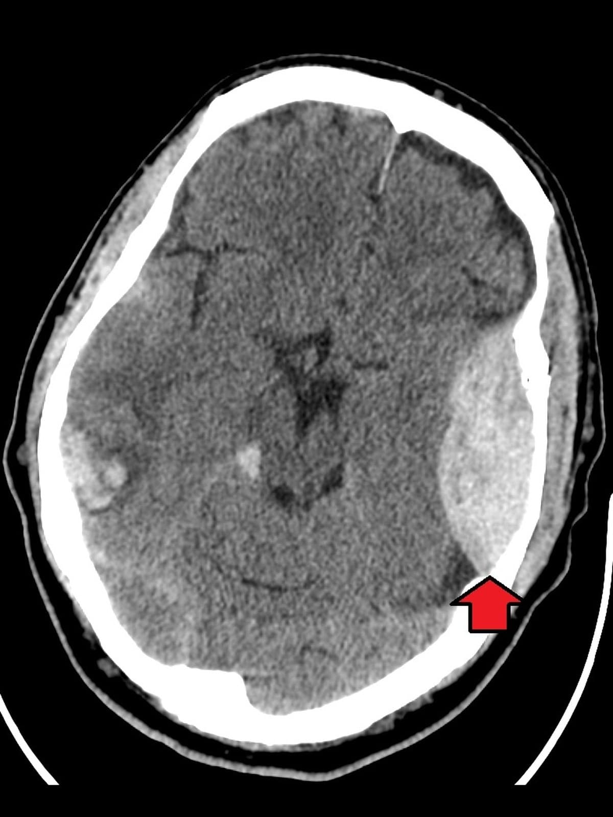 Epidural hematoma on an axial head CT: lens-shaped bright blood against the skull (arrow)