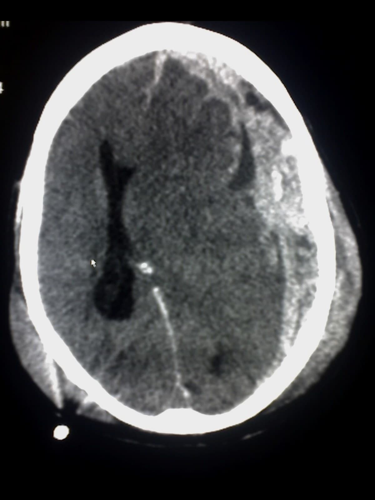 Acute subdural hematoma on an axial head CT: bright crescent along the brain with midline shift