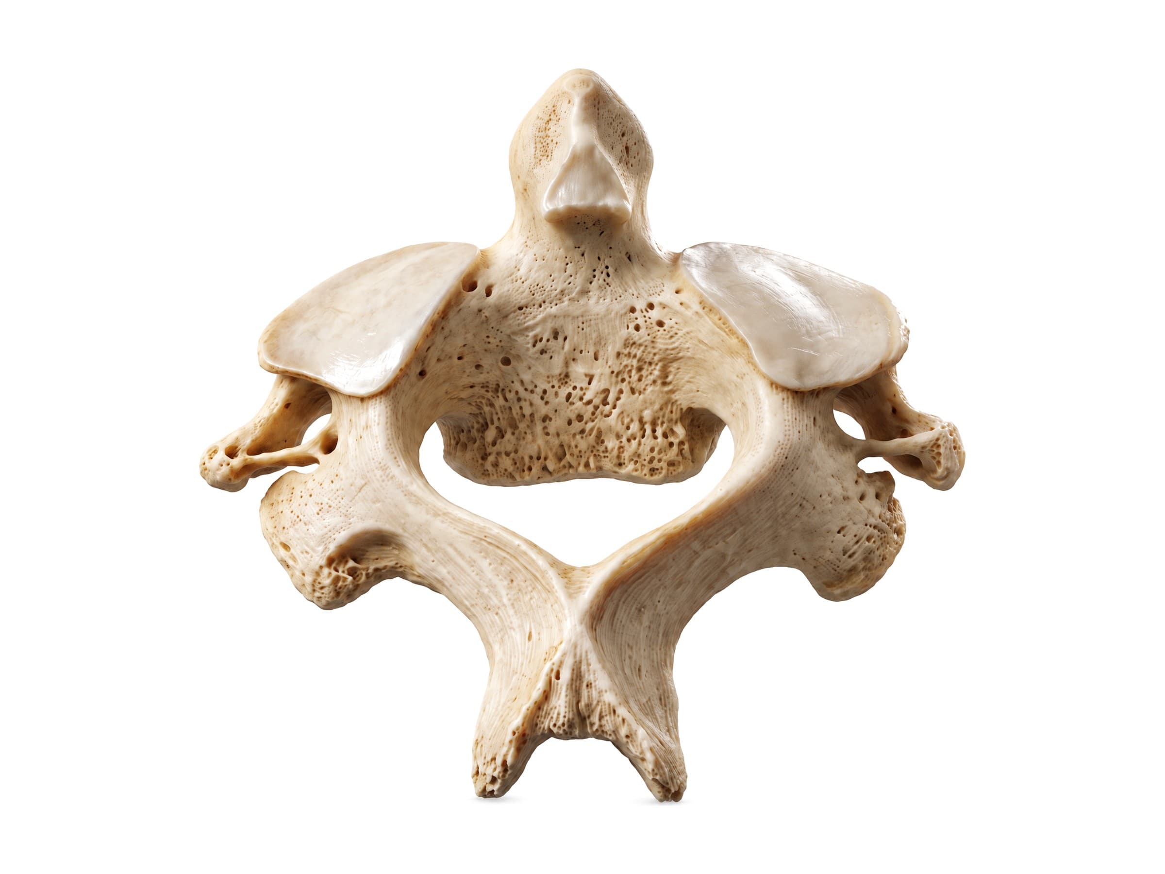 Axis (C2) vertebra from above and behind: dens, superior articular surfaces and bifid spinous process