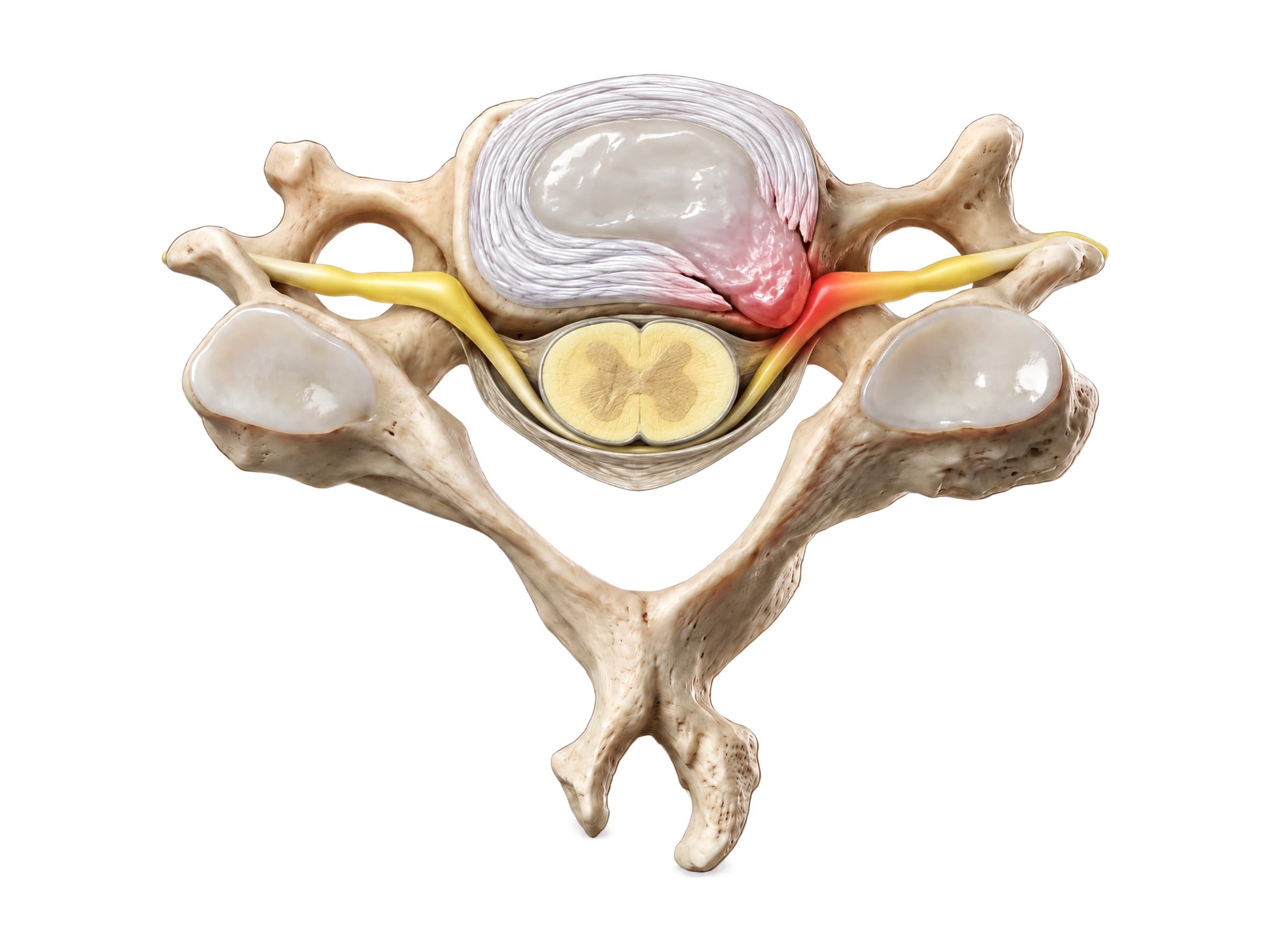 Cervical disc herniation (top view): nucleus pulposus pushing through the annulus onto a nerve root