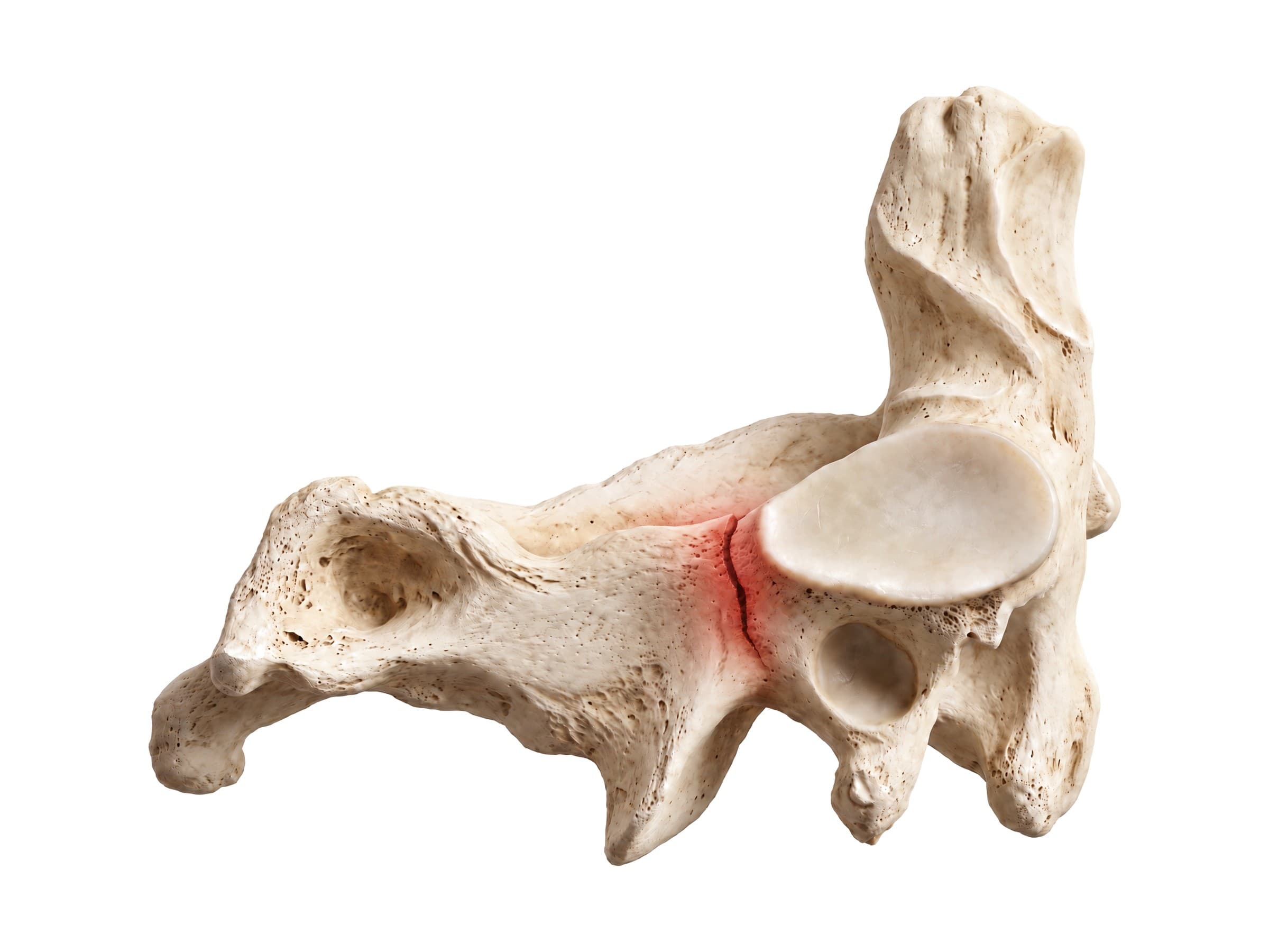 Hangman's fracture of C2 (side view): break through the pars interarticularis shown in red