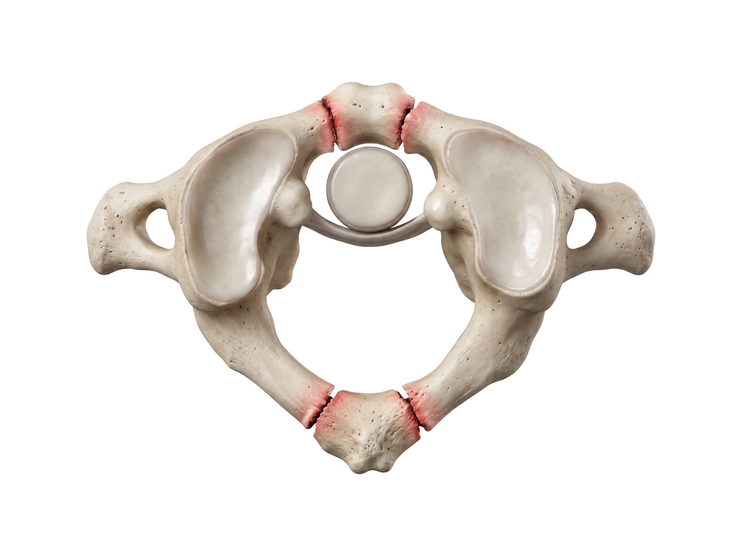 Jefferson fracture of the atlas (C1, top view): breaks in the anterior and posterior arches shown in red