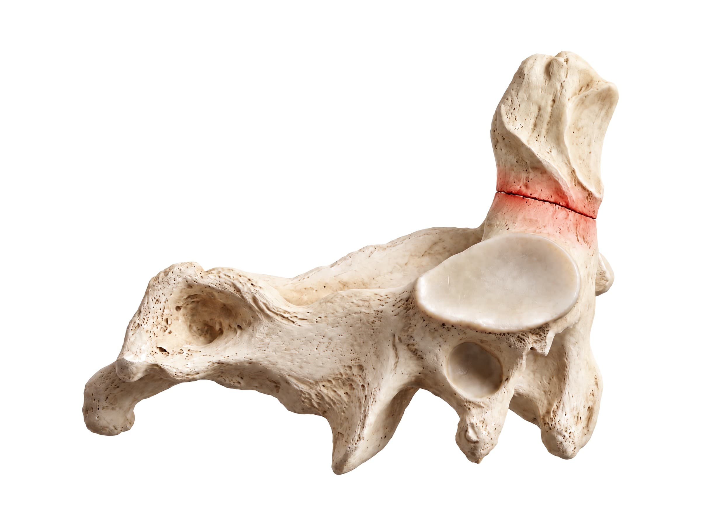 Odontoid fracture (type II, side view of C2): break across the base of the dens shown in red