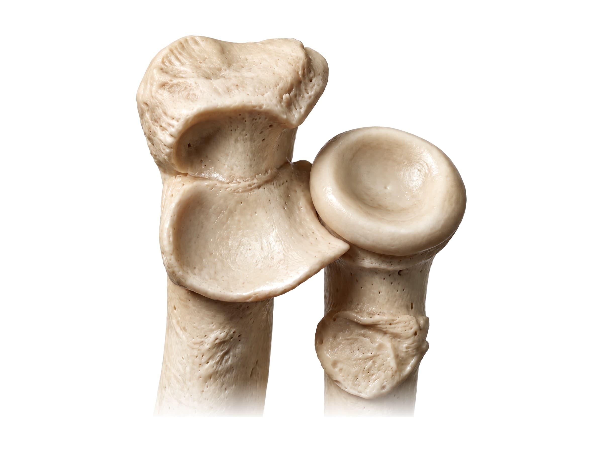 Upper ulna and radius (left elbow, front): olecranon, trochlear notch, coronoid process and radial head