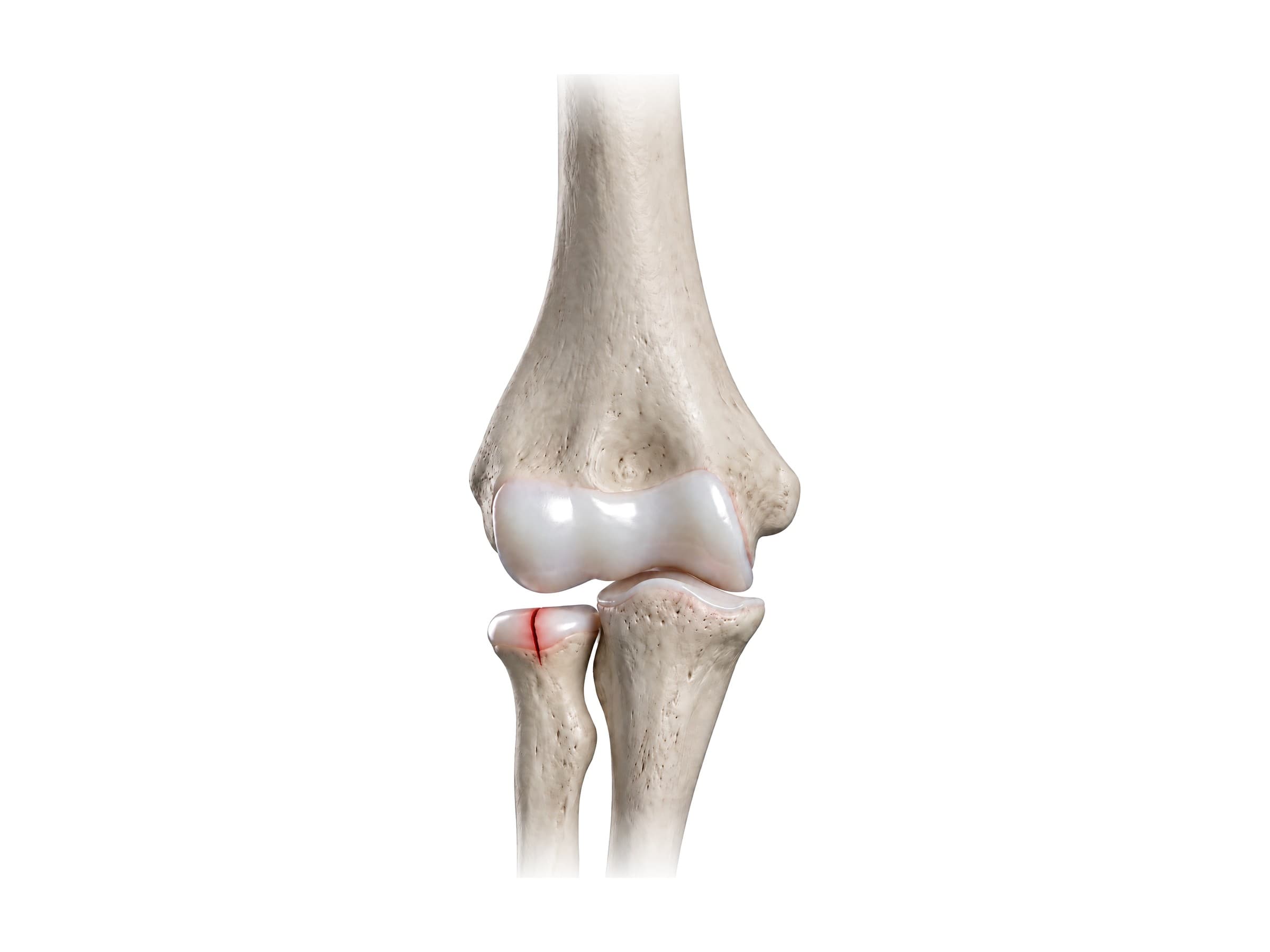 Radial head fracture of the elbow, highlighted in red (right elbow)