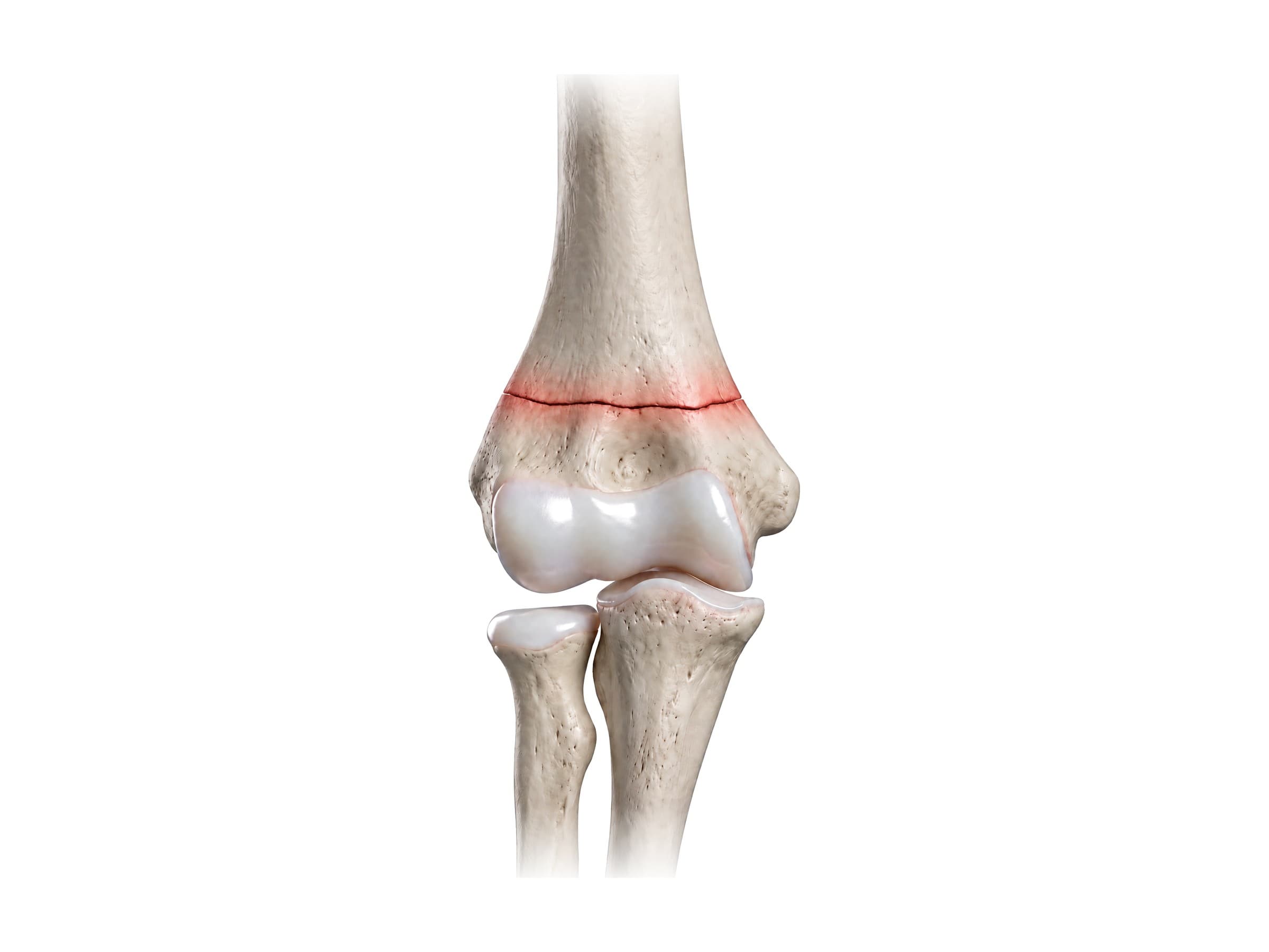 Supracondylar humerus fracture just above the elbow joint, highlighted in red (right elbow)