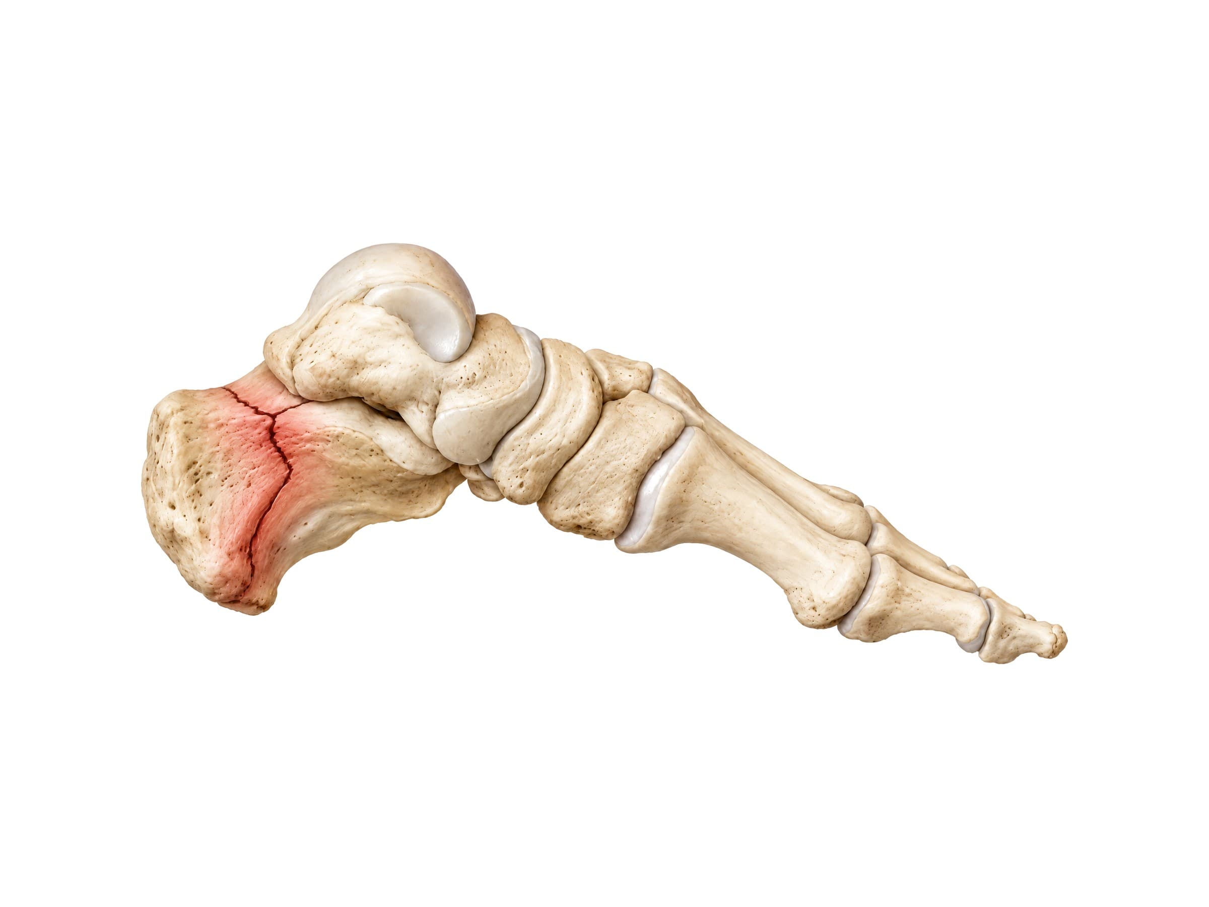 Calcaneus (heel bone) fracture (left foot, inner side)