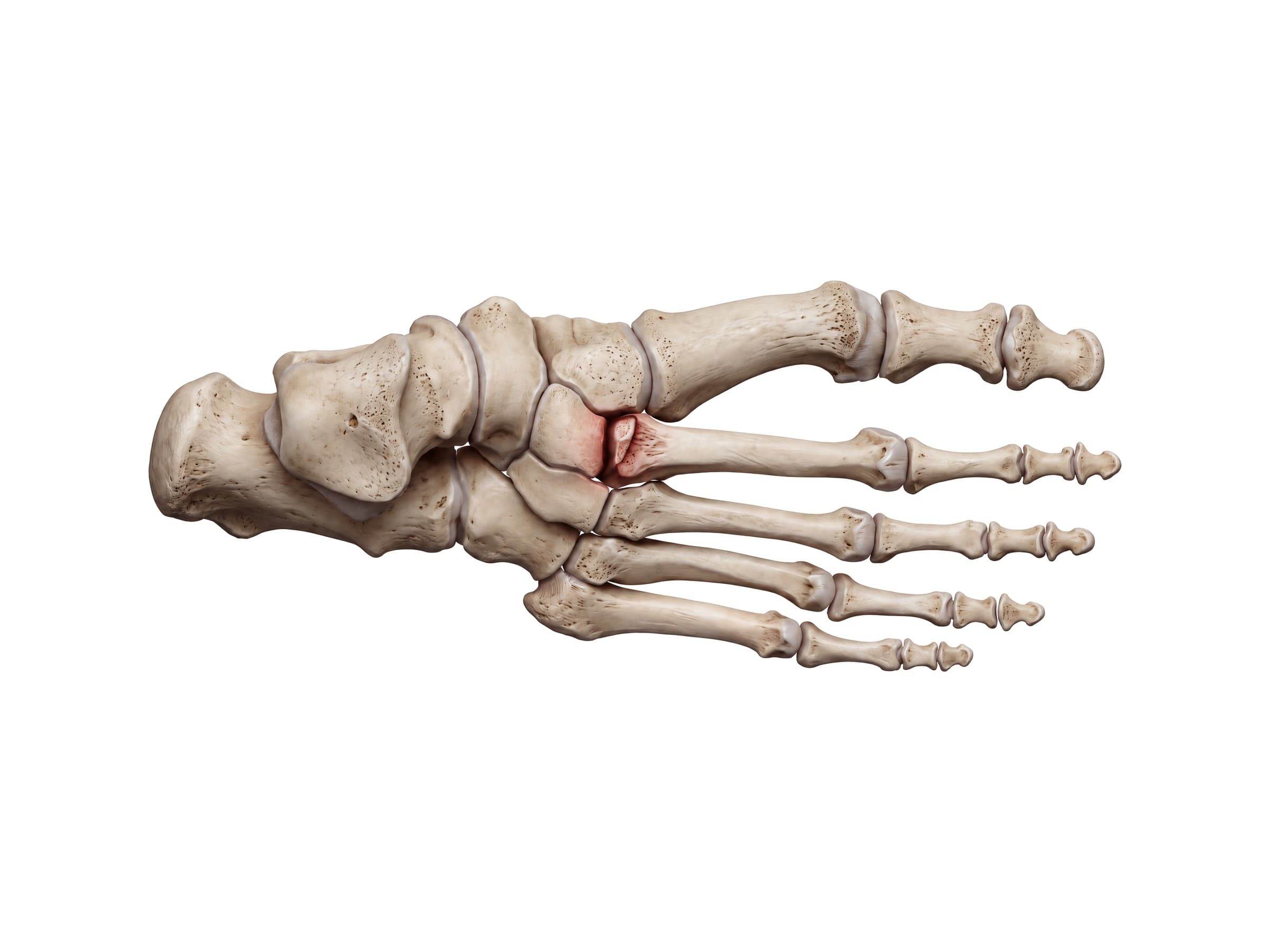 Lisfranc injury at the base of the second metatarsal (right foot, top view)
