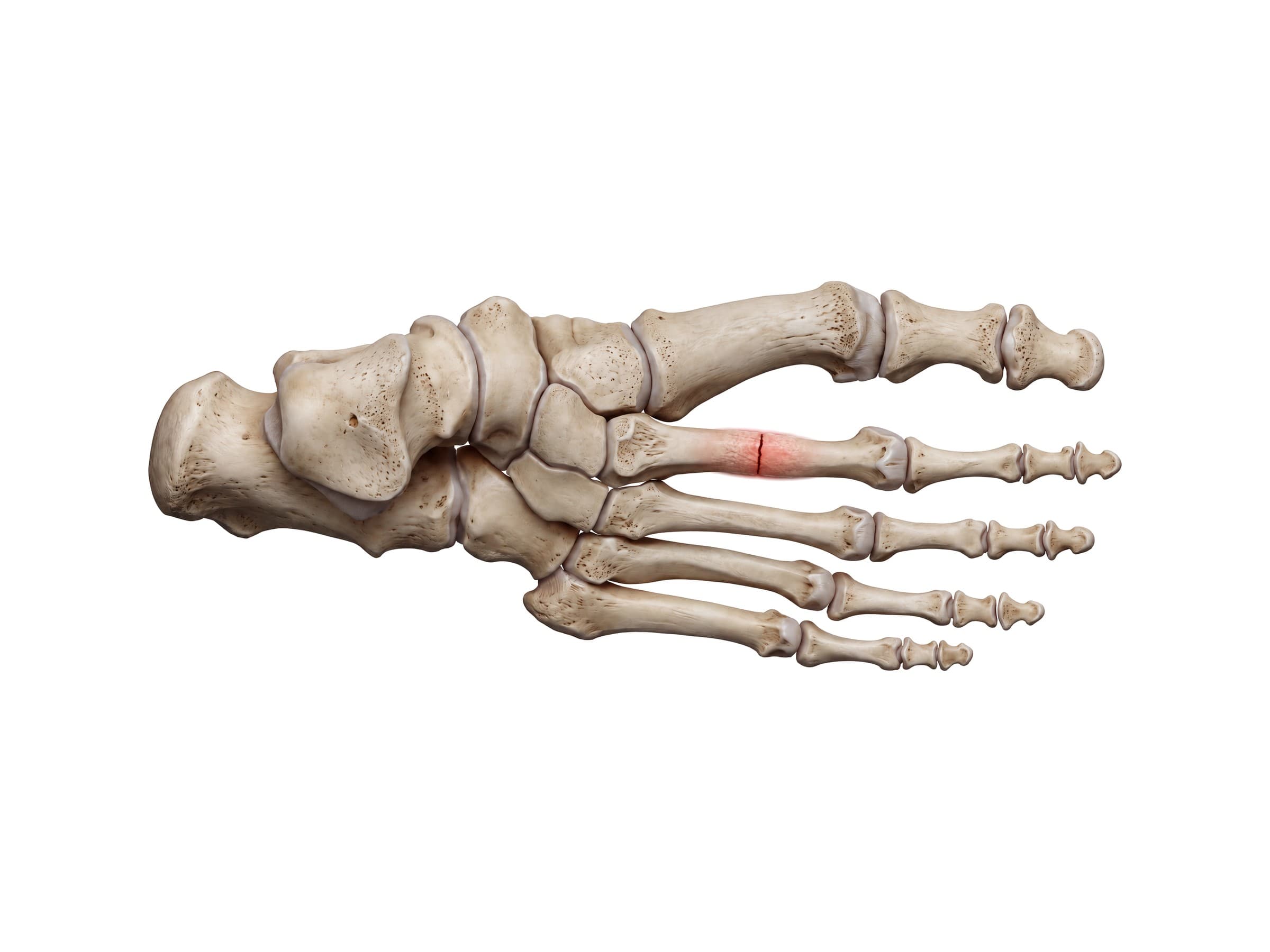 Metatarsal stress fracture of the second metatarsal shaft (right foot, top view)
