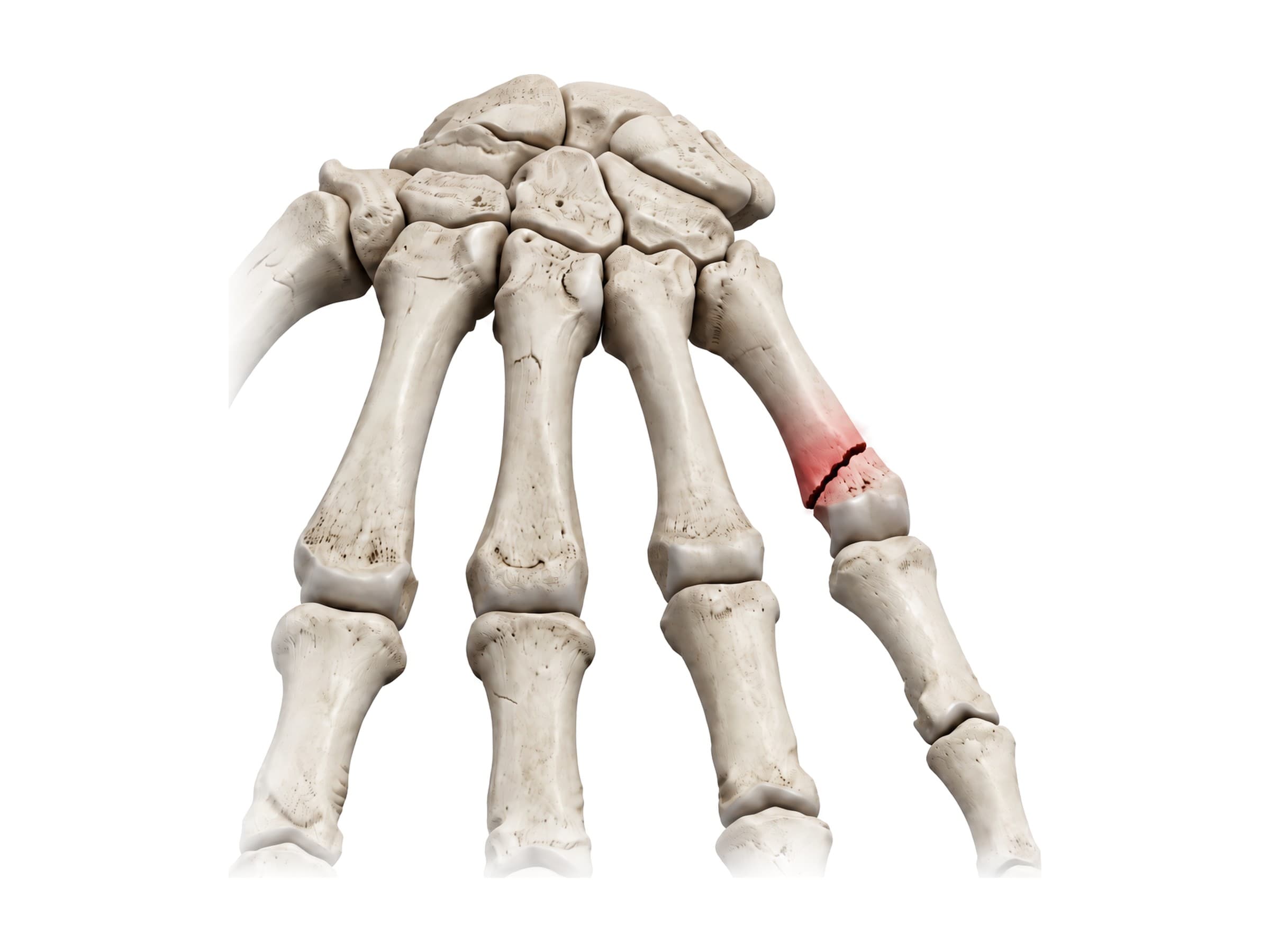 Boxer's fracture of the fifth metacarpal neck, highlighted in red