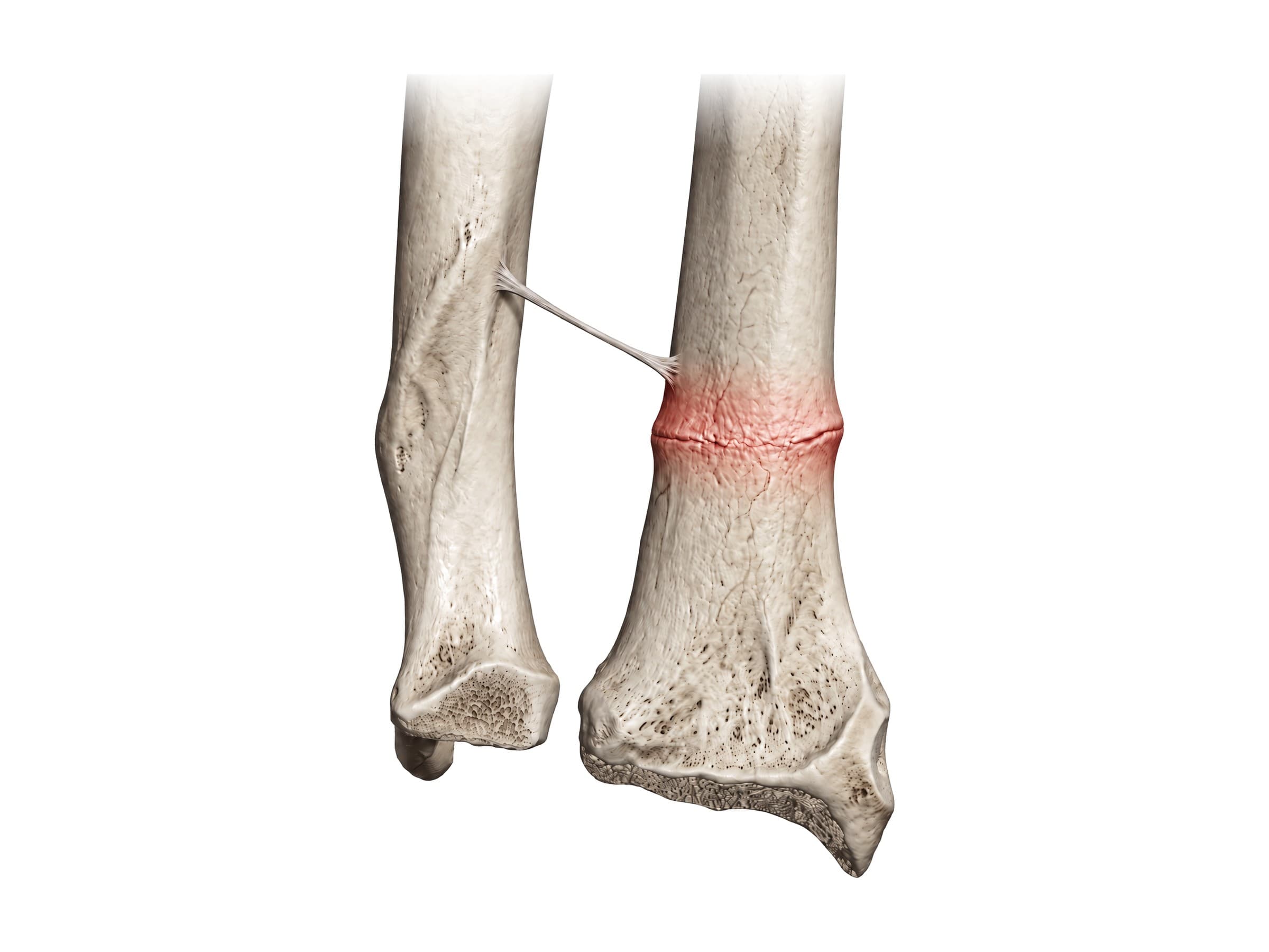 Buckle (torus) fracture of the distal radius, highlighted in red