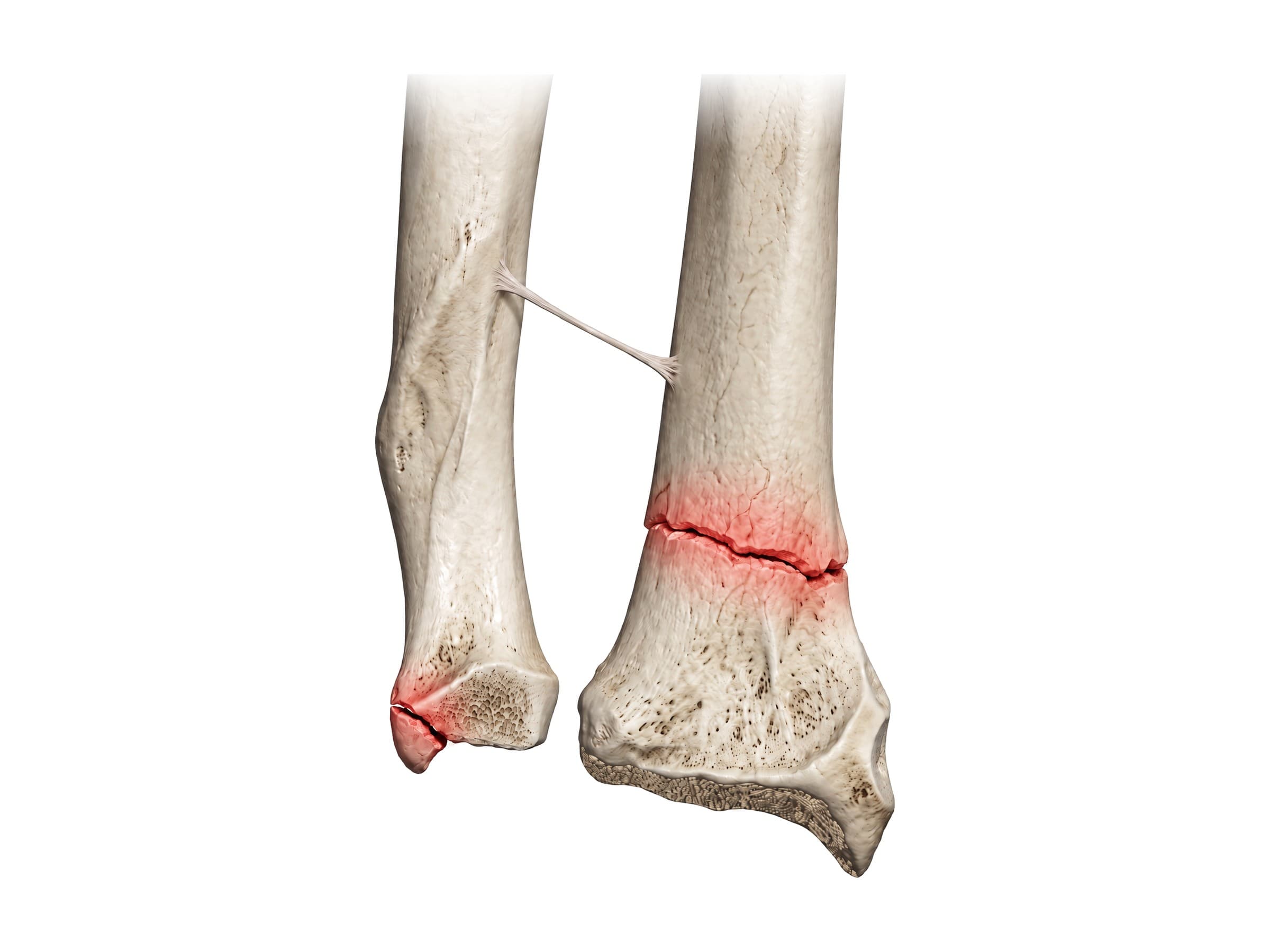 Colles fracture of the distal radius with an ulnar styloid fracture, highlighted in red