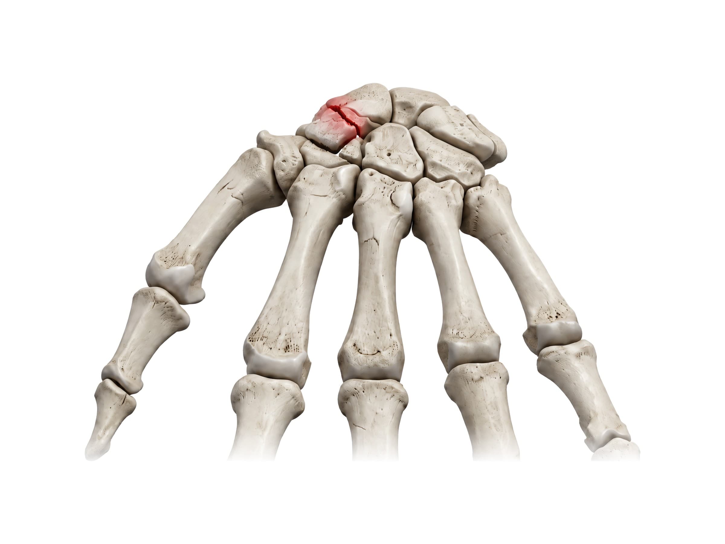 Scaphoid fracture through the waist of the scaphoid, highlighted in red