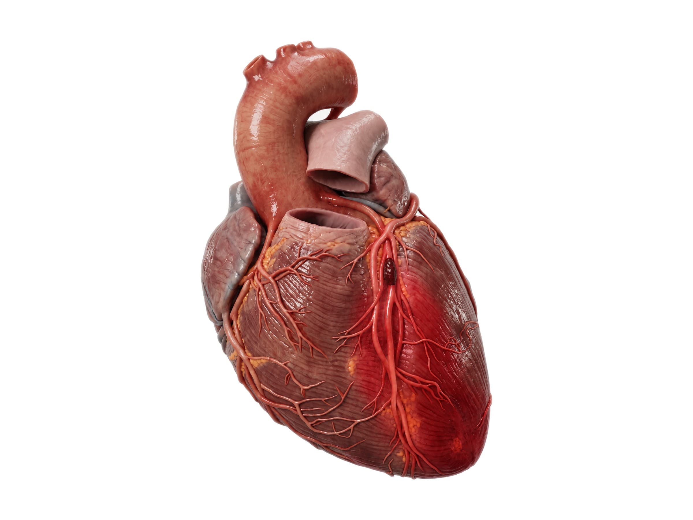 Heart attack (anterior MI): clot blocking the LAD artery, damaged front wall of the heart in red