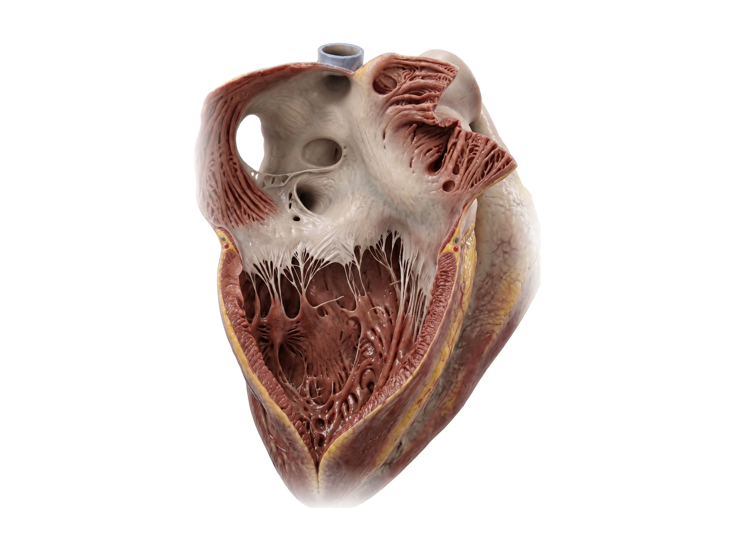 Right atrium and right ventricle opened: tricuspid valve, fossa ovalis, chordae tendineae