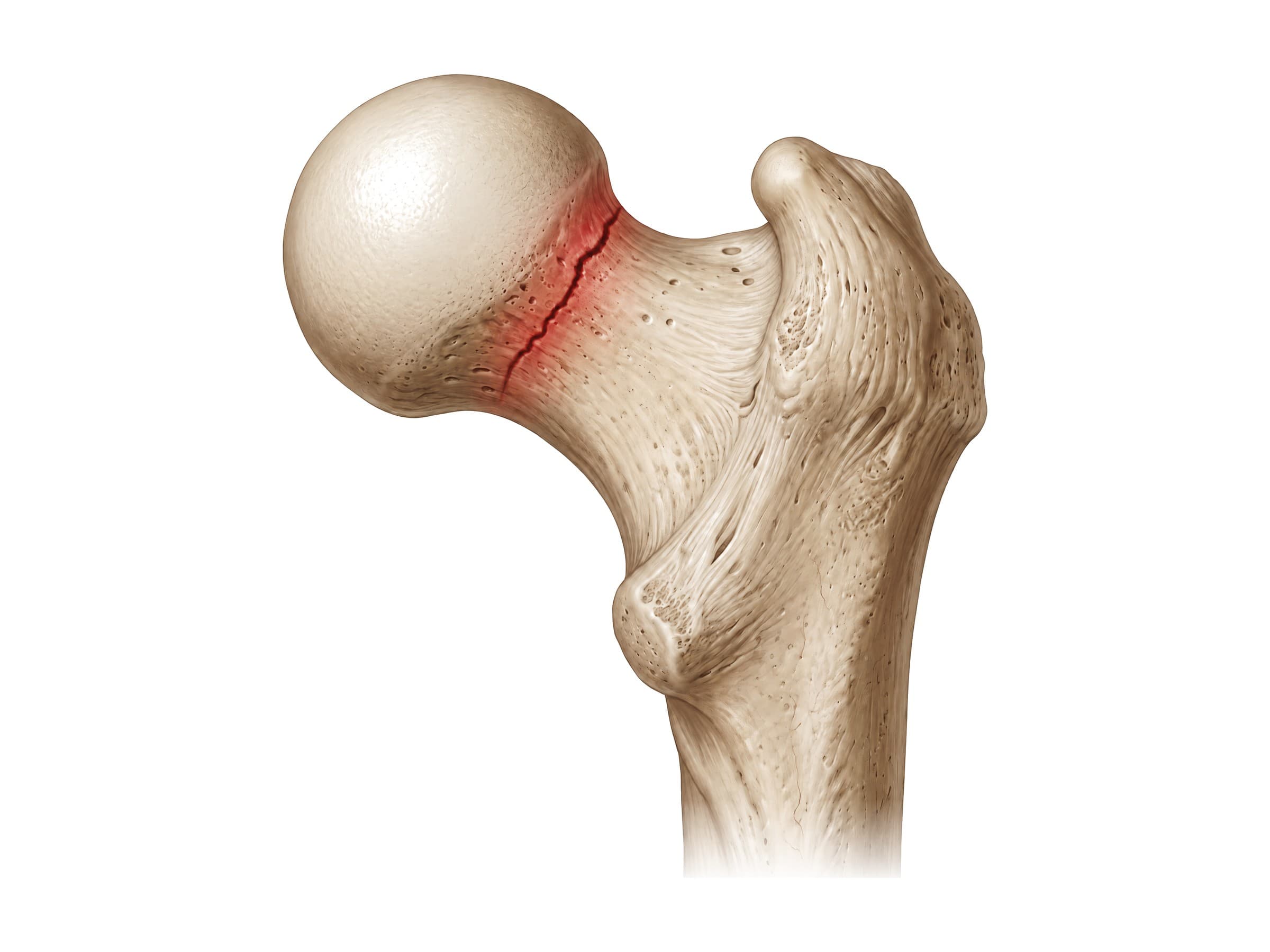 Femoral neck fracture just below the femoral head, highlighted in red (right femur)