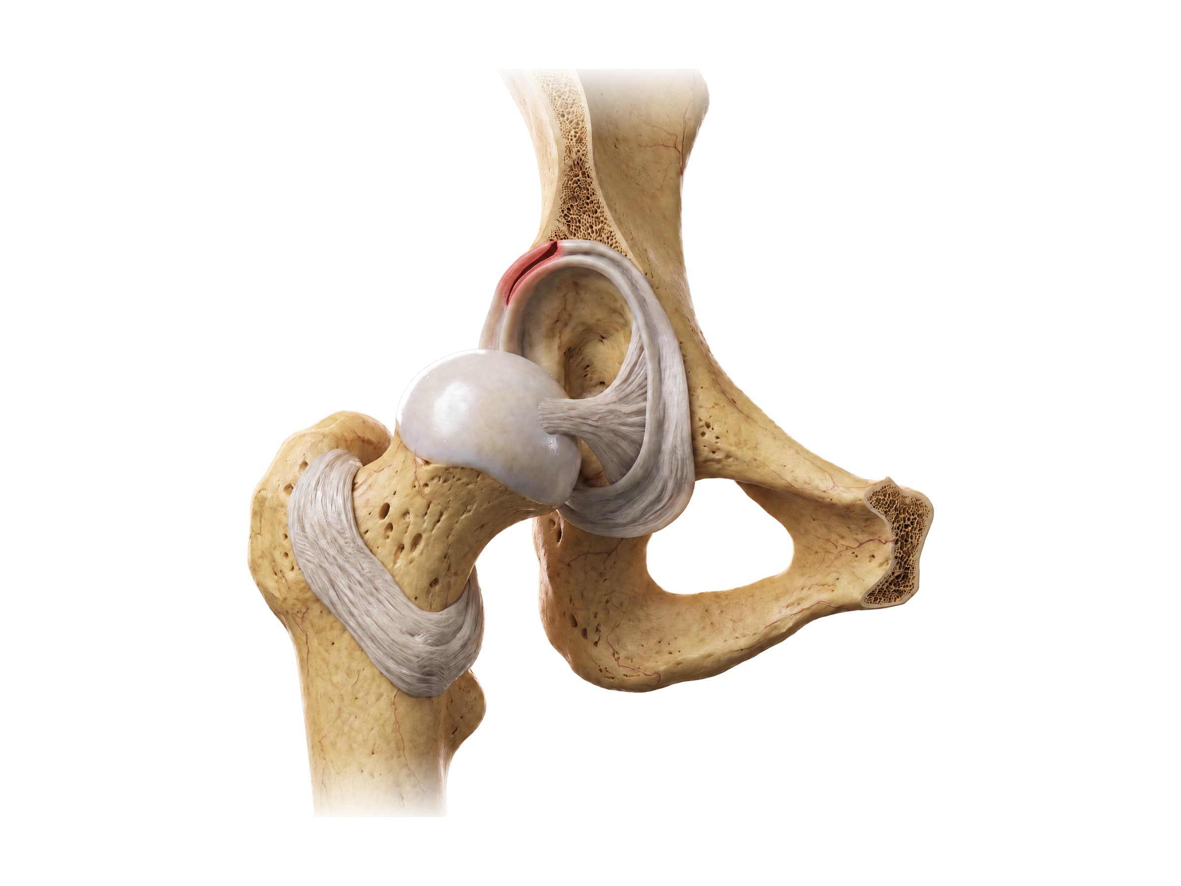 Hip labral tear at the upper front rim of the acetabulum, highlighted in red (right hip)