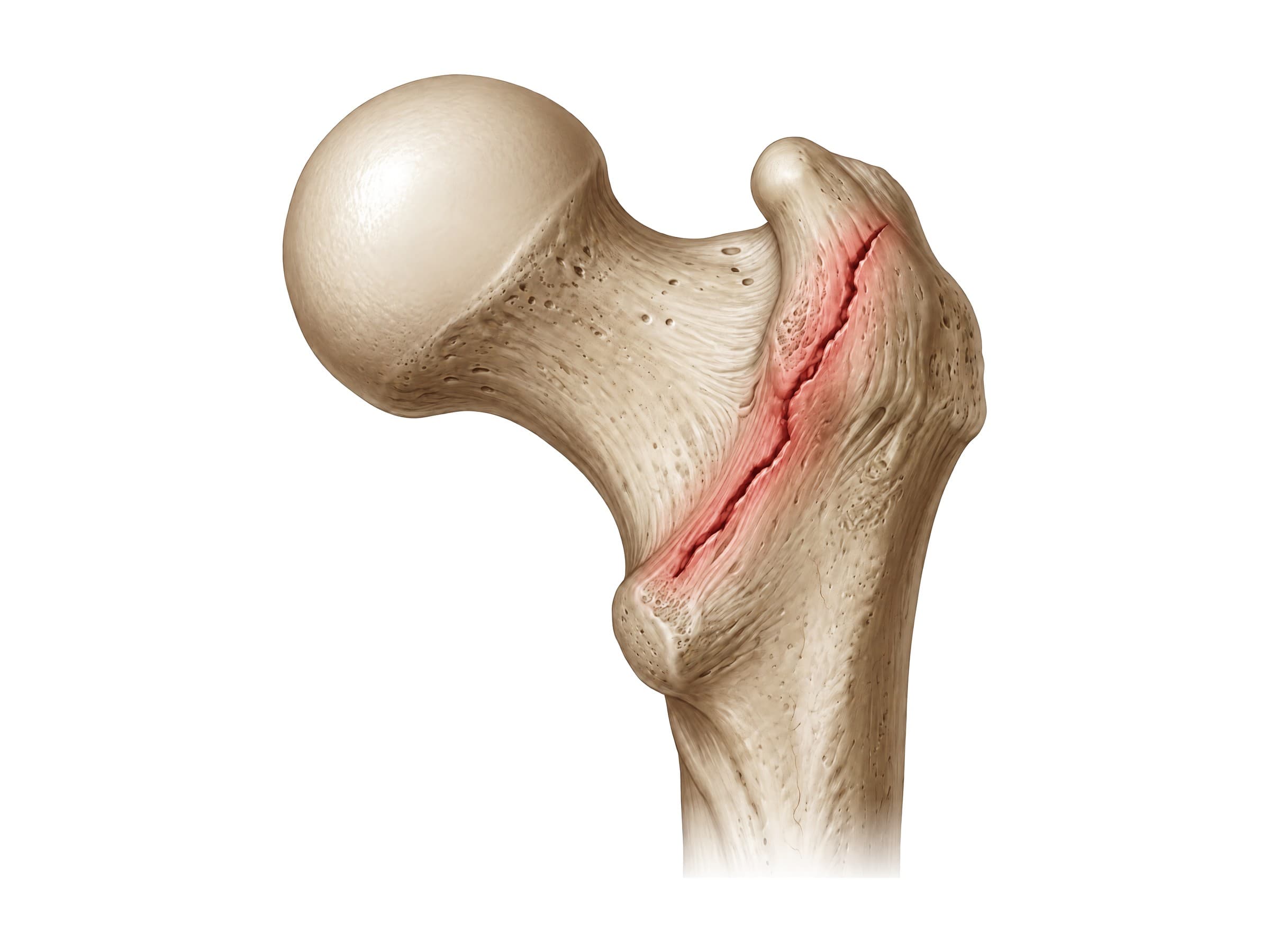Intertrochanteric hip fracture between the greater and lesser trochanter, highlighted in red (right femur)