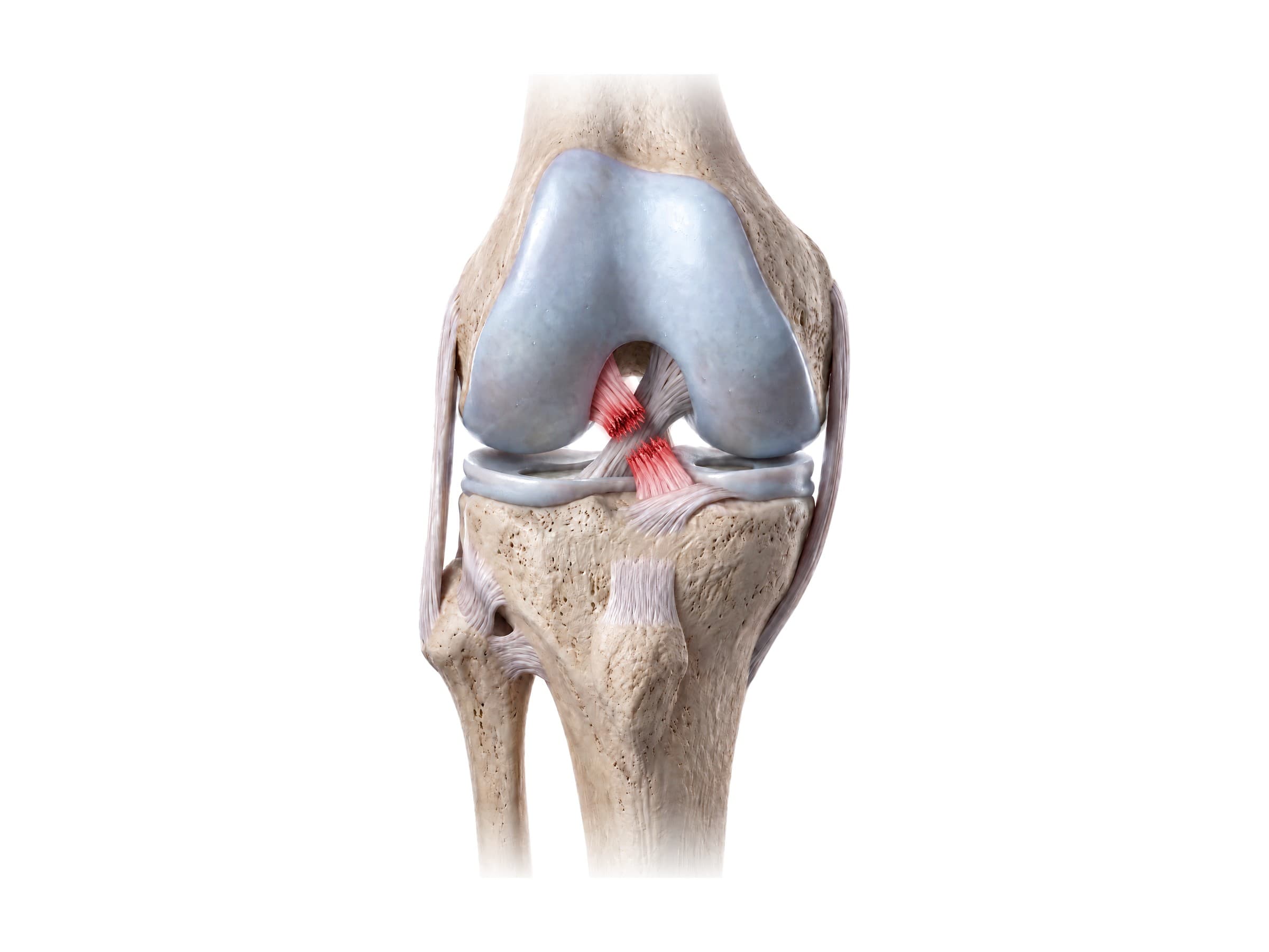 ACL tear (right knee, front view): torn anterior cruciate ligament highlighted in red