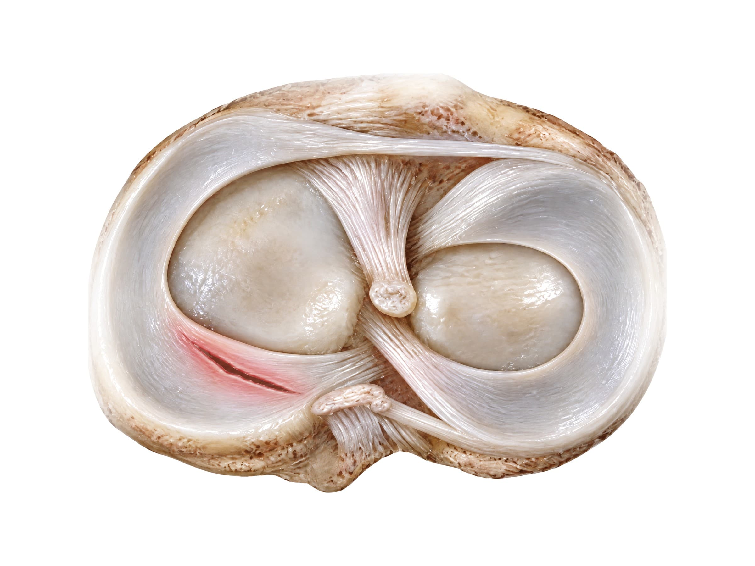 Medial meniscus tear in the posterior horn (right knee, seen from above)