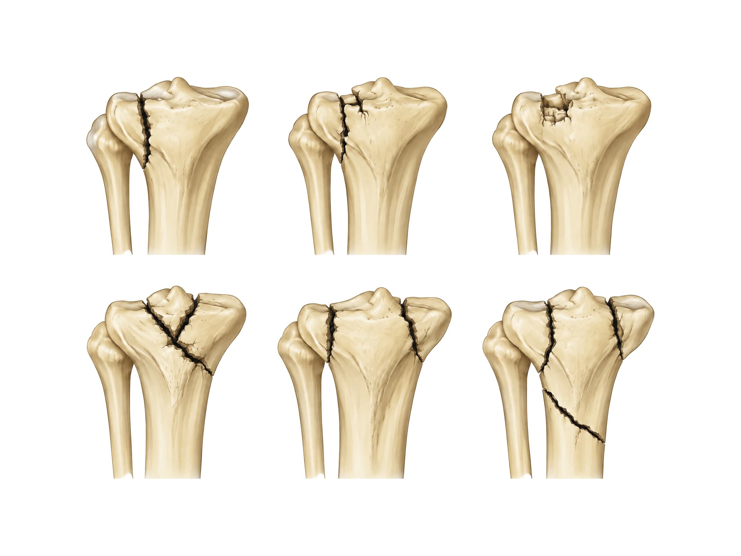 Schatzker classification of tibial plateau fractures, Types I to VI