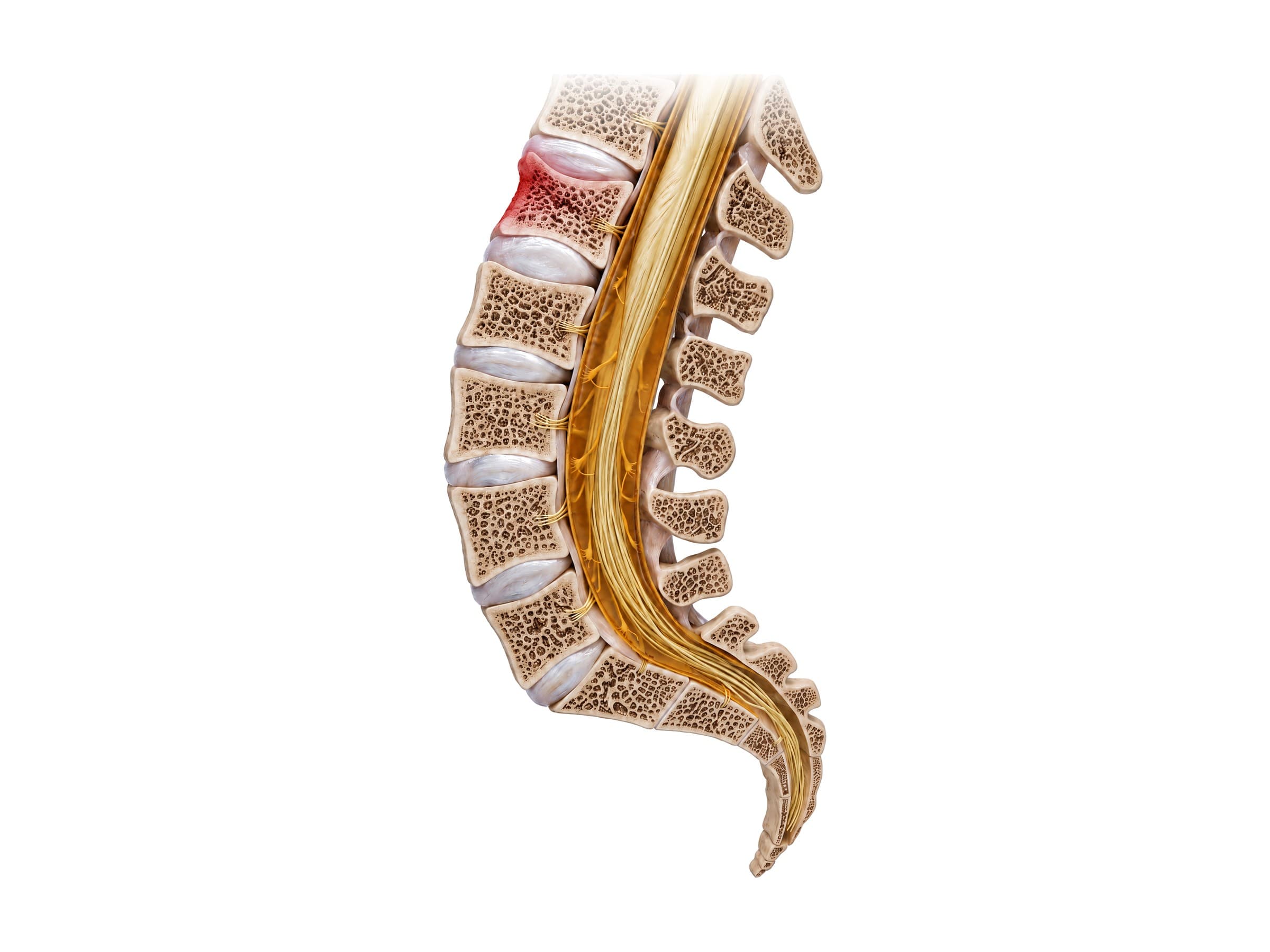 L1 compression fracture (midline section): wedge-shaped collapse of the vertebral body in red