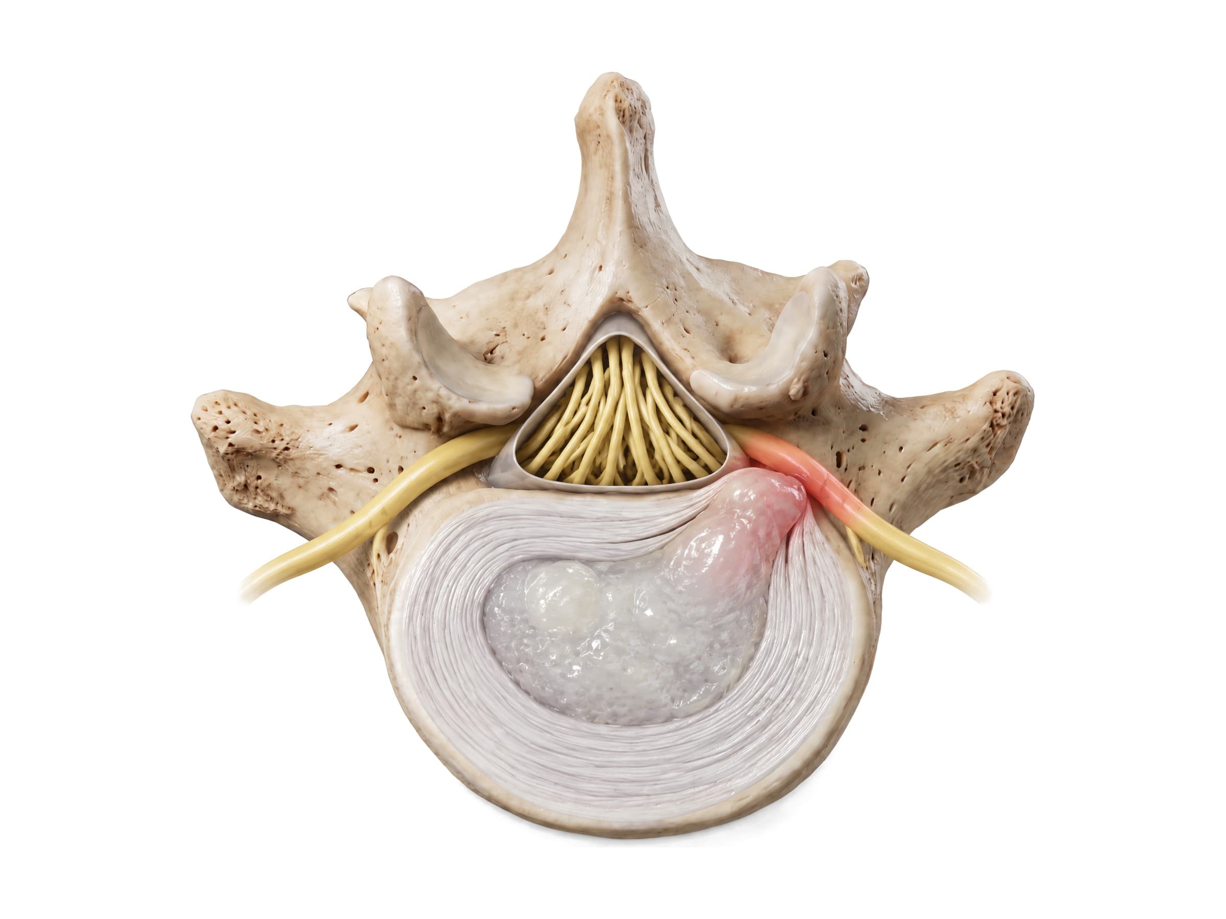 Lumbar disc herniation (top view): nucleus pulposus pushing through the annulus onto a nerve root