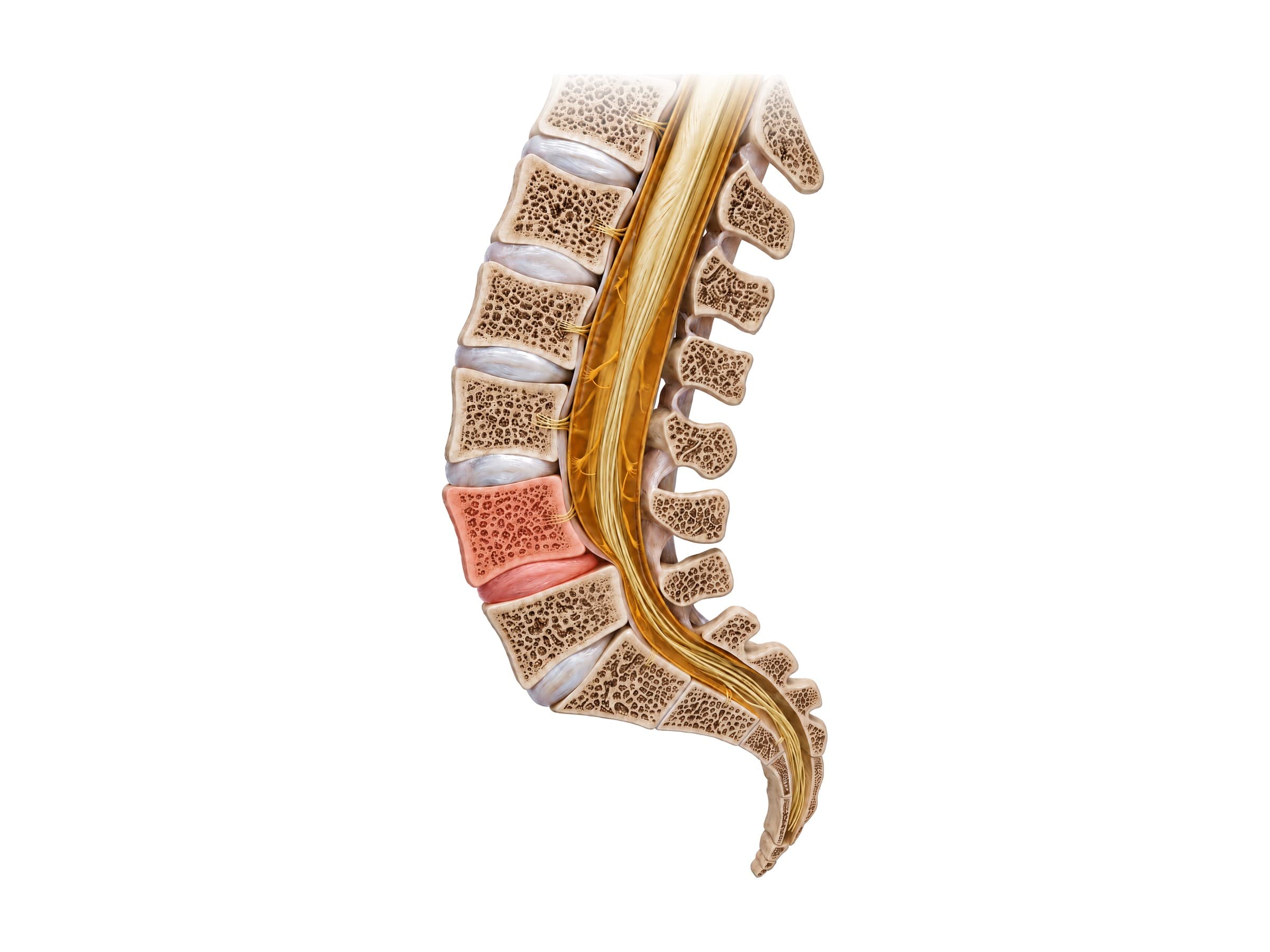 Spondylolisthesis (midline section): L4 slipped forward on L5, shown in red