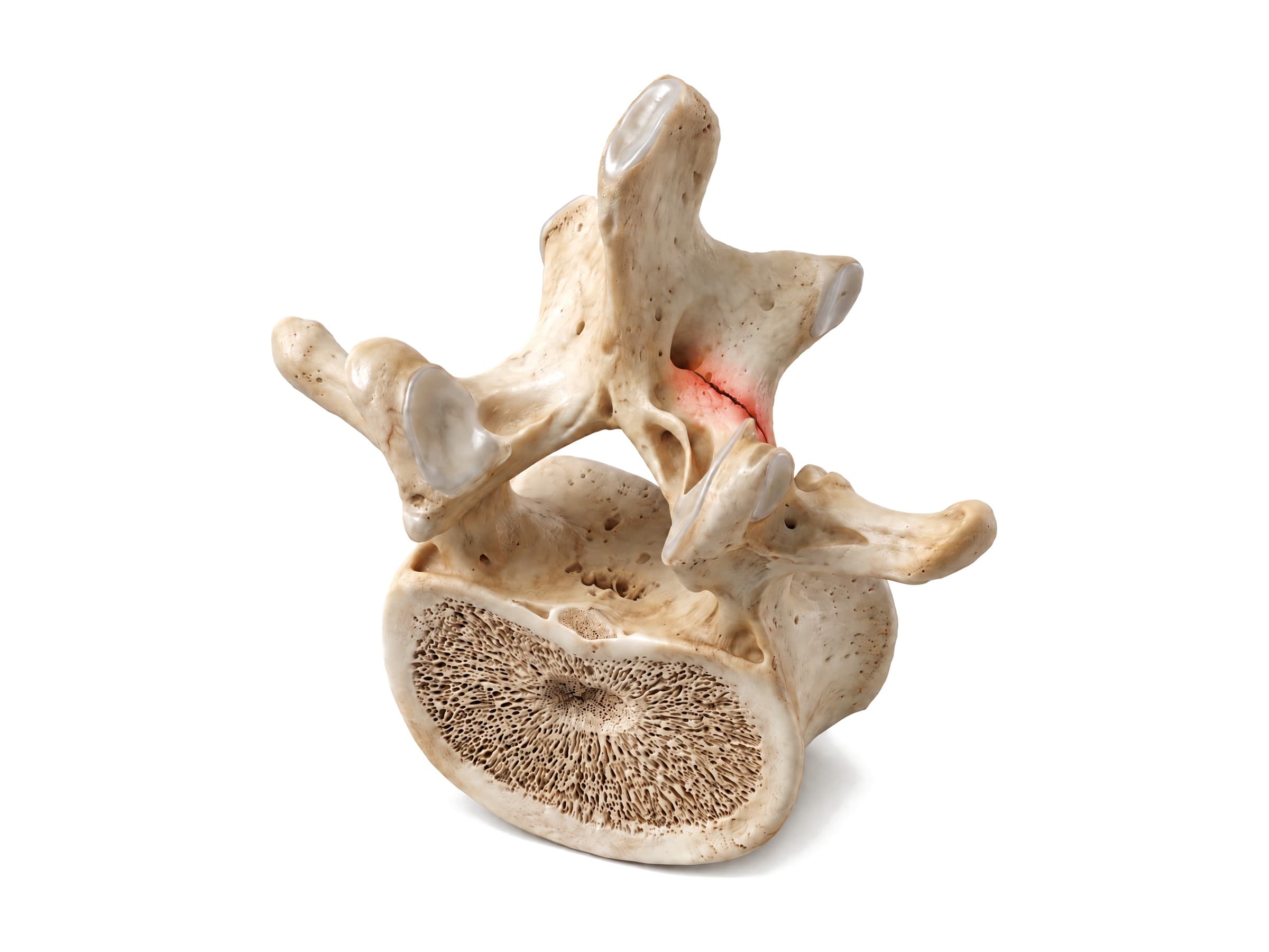 Spondylolysis (lumbar vertebra from above and behind): stress fracture of the pars interarticularis in red