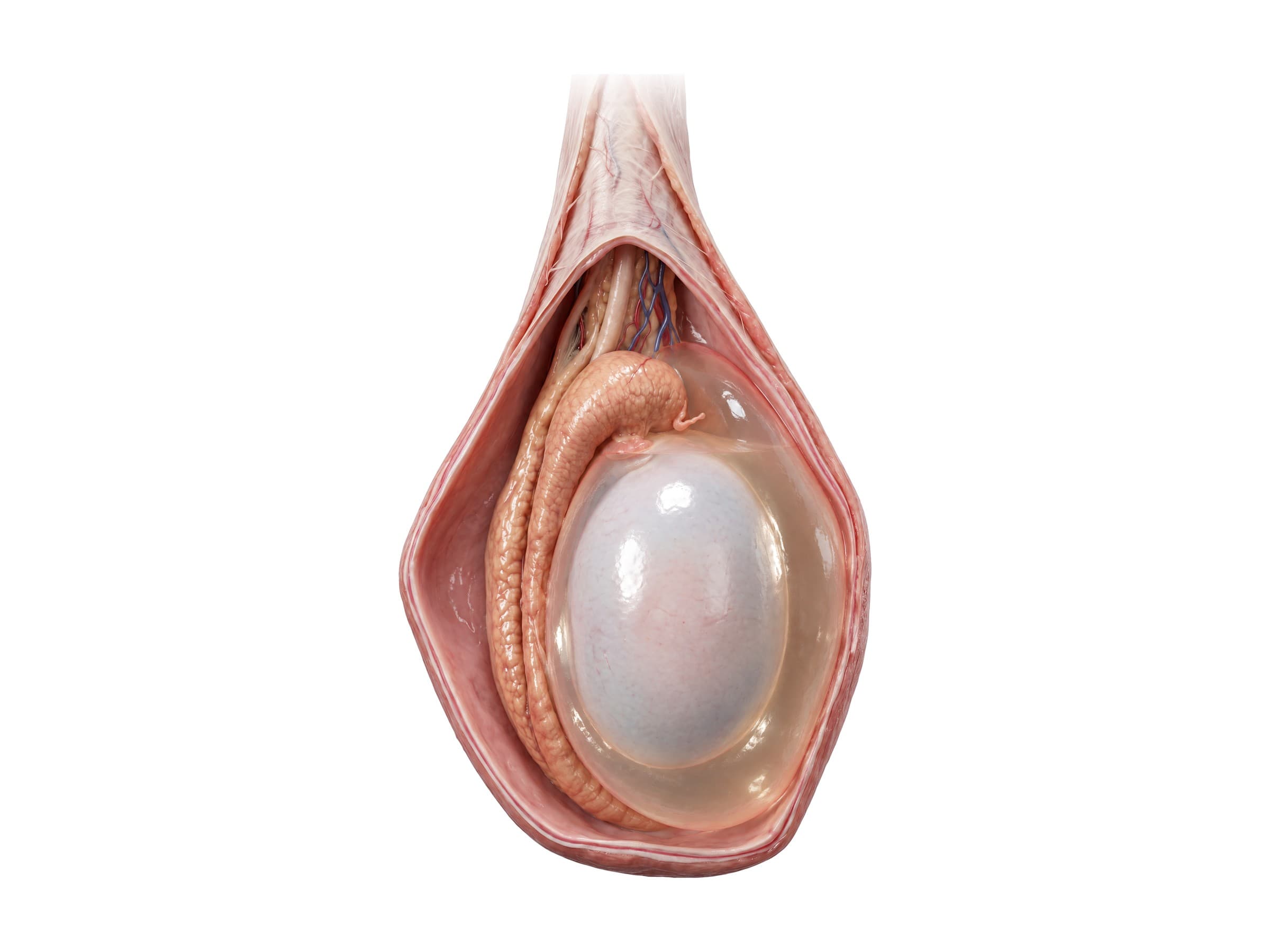 Hydrocele (right testis, side view): clear fluid filling the tunica vaginalis around the testis