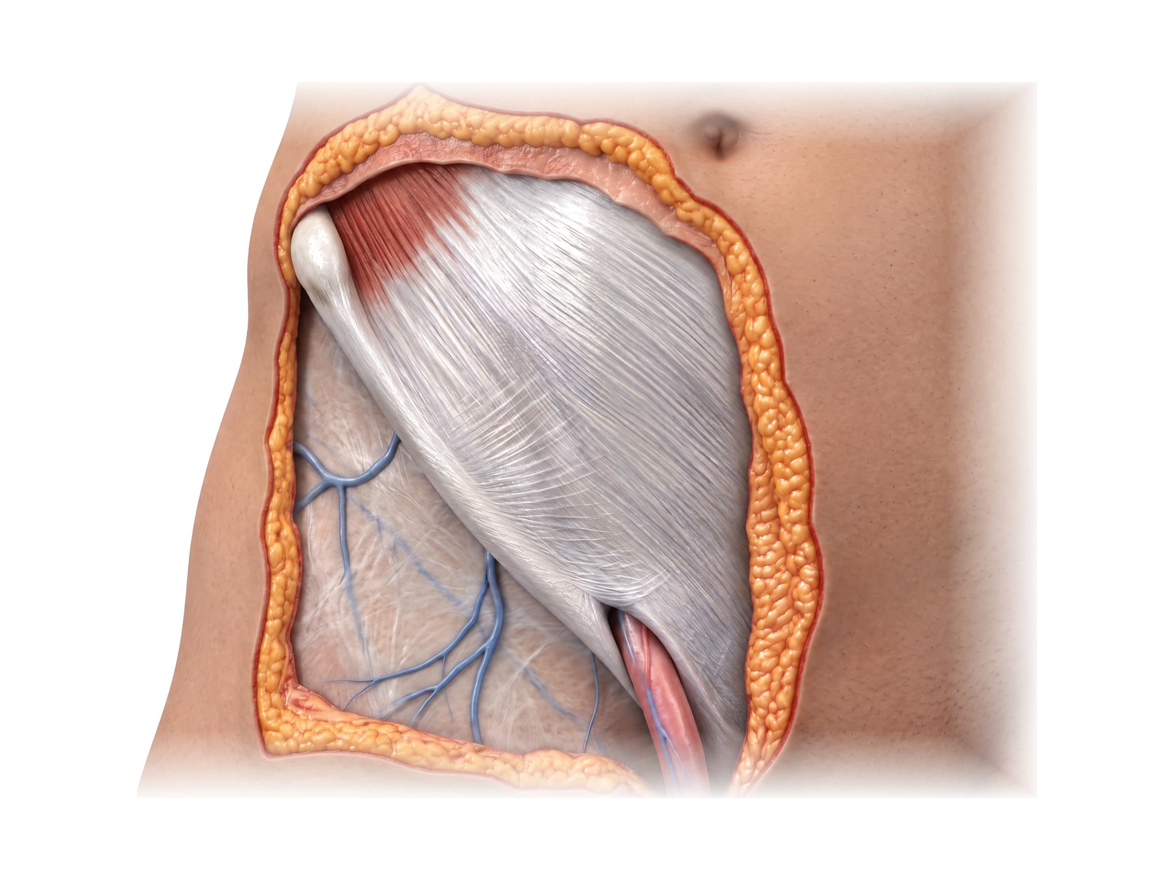 Inguinal canal and spermatic cord at the superficial inguinal ring, above the inguinal ligament (right groin, front view)