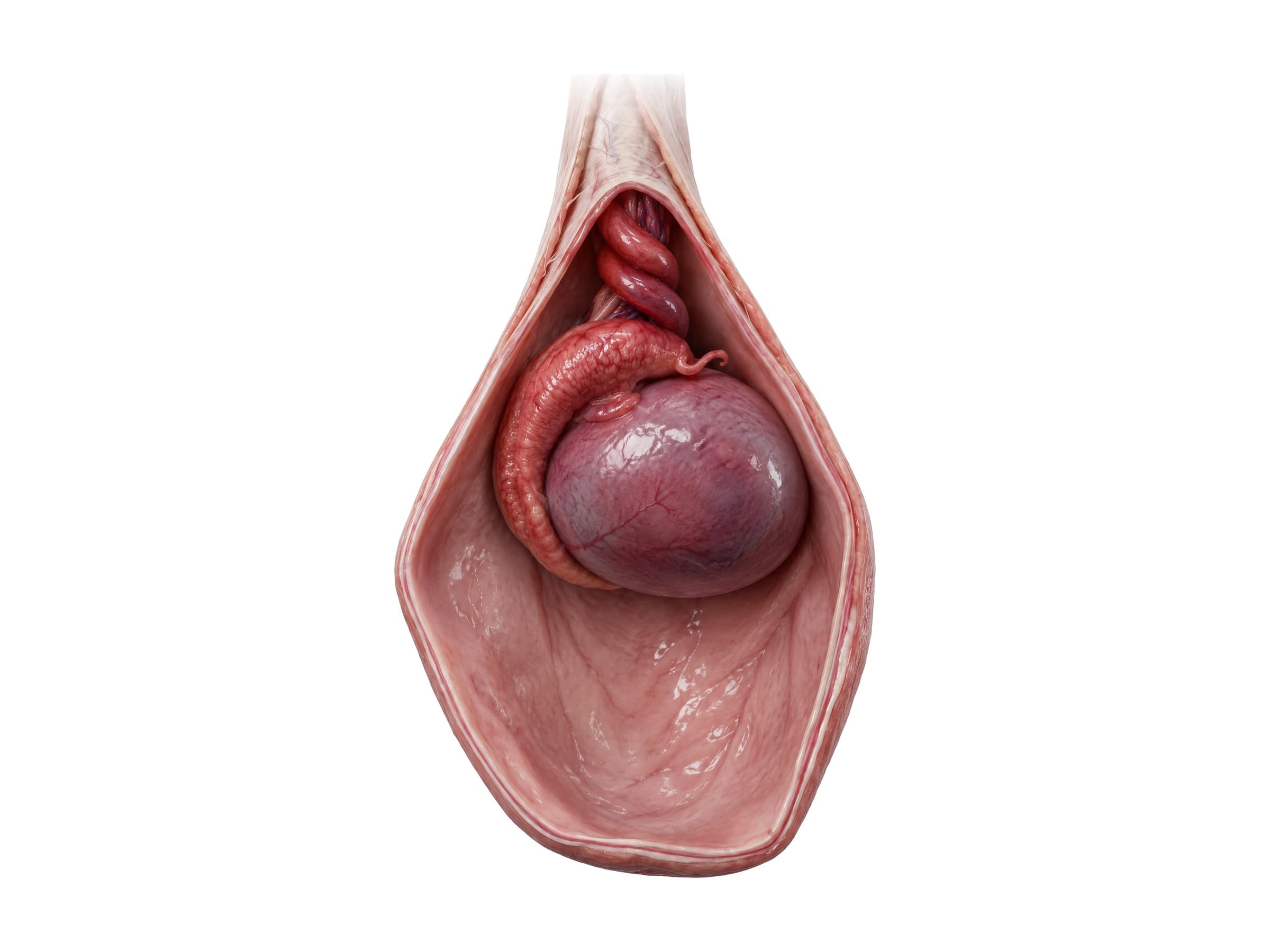 Testicular torsion (right testis, side view): spermatic cord twisted above a rotated, high-riding testis