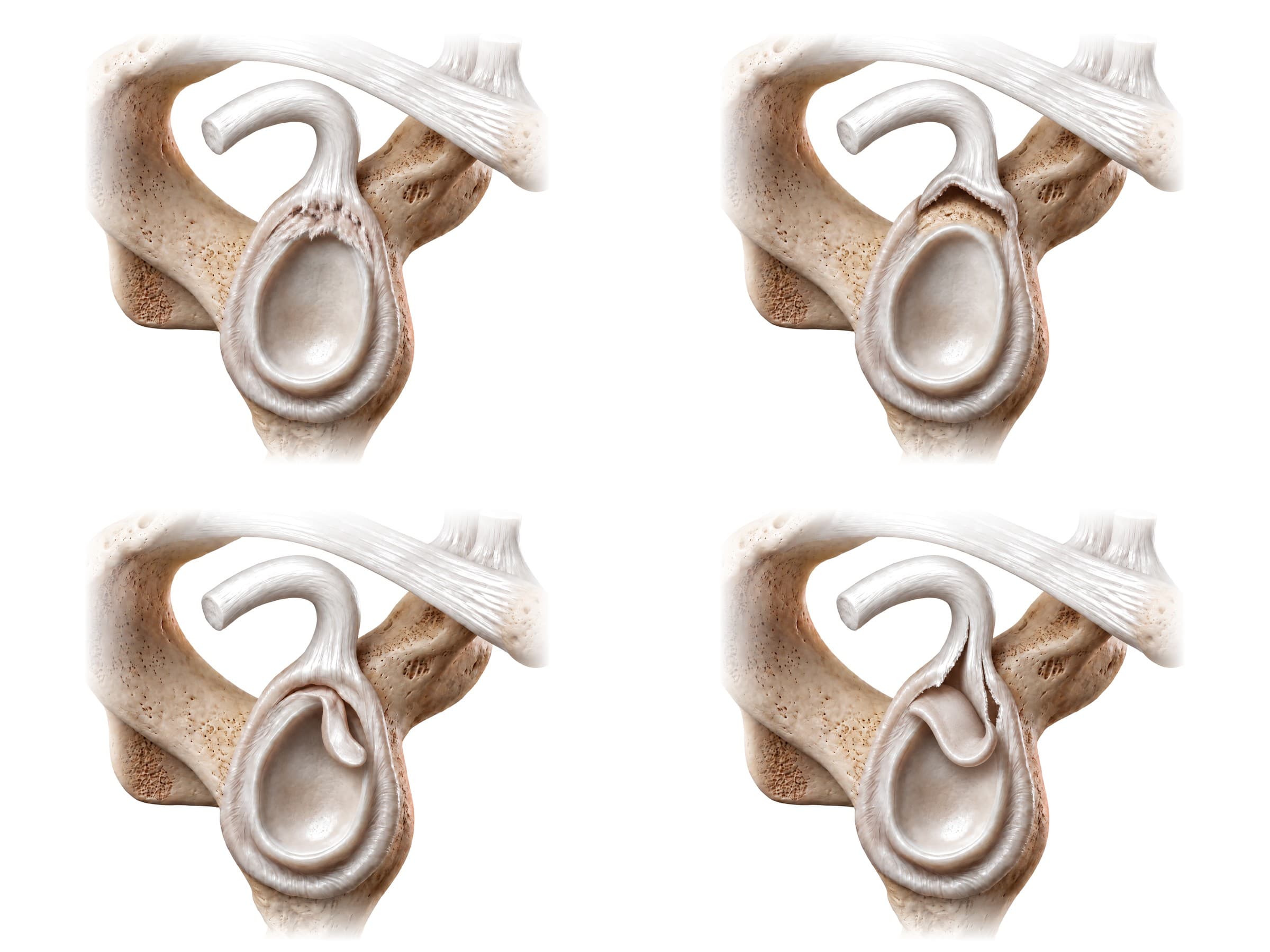 SLAP tear classification: Snyder Types I to IV of the glenoid labrum