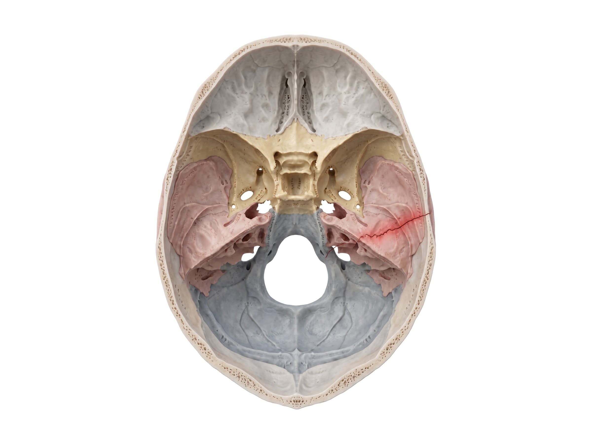 Basilar skull fracture through the petrous temporal bone, highlighted in red (skull base from above)