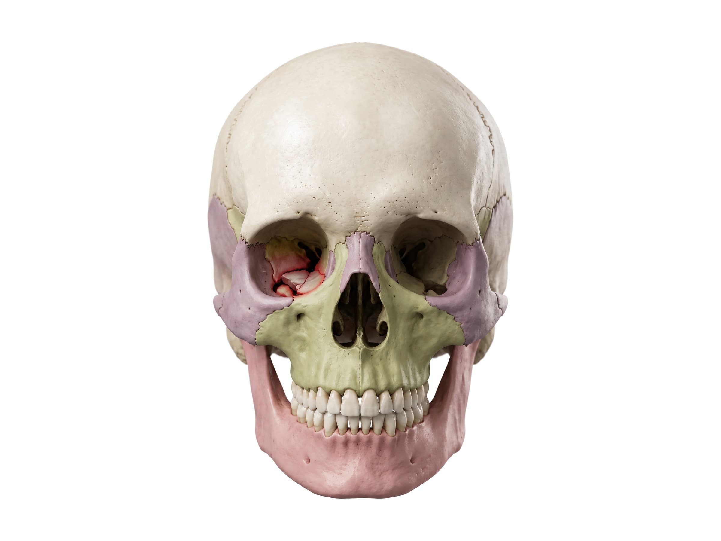 Orbital blowout fracture of the floor of the right eye socket, highlighted in red (front view)