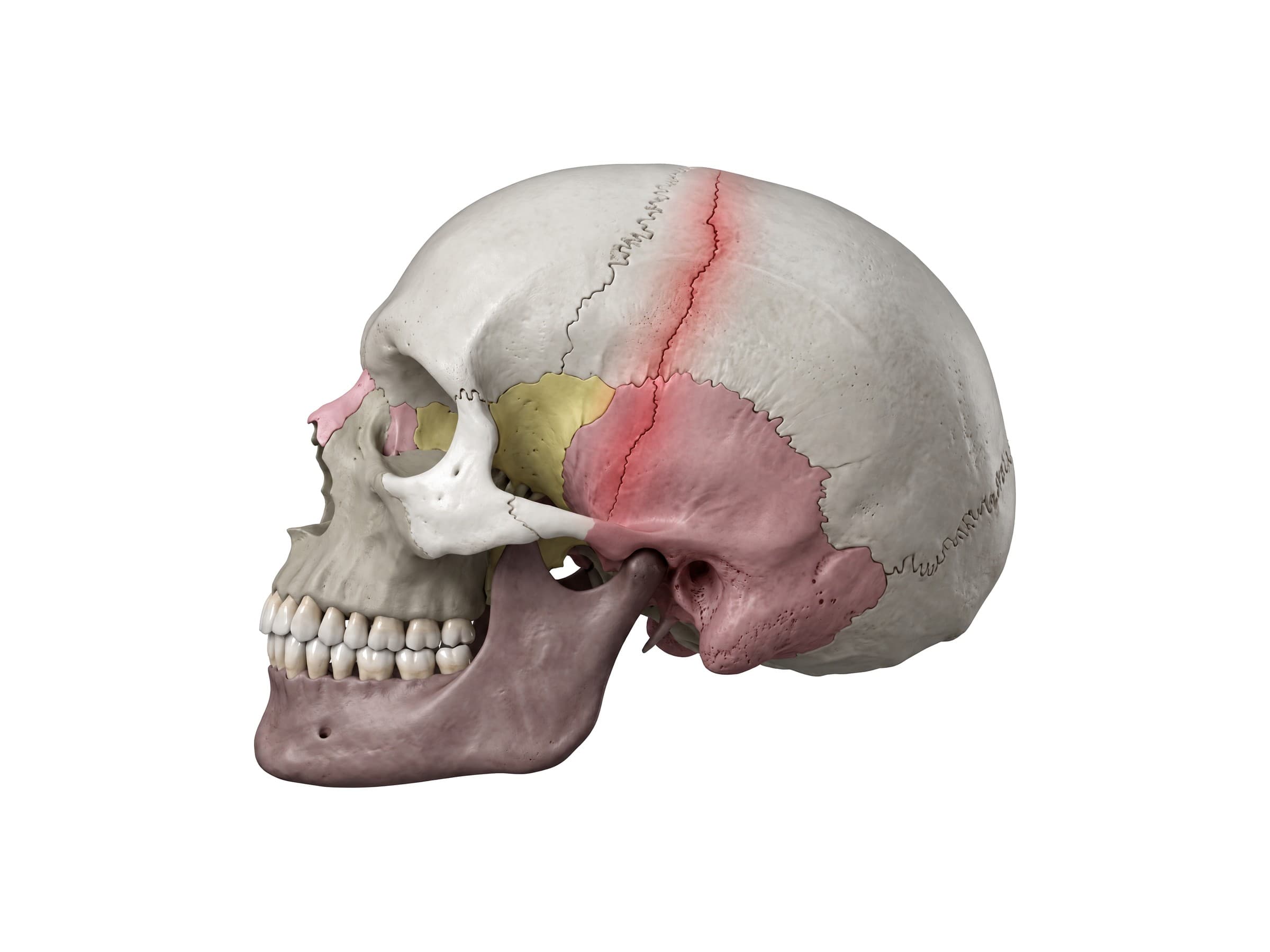 Linear skull fracture through the temporal bone near the pterion, highlighted in red (left side)