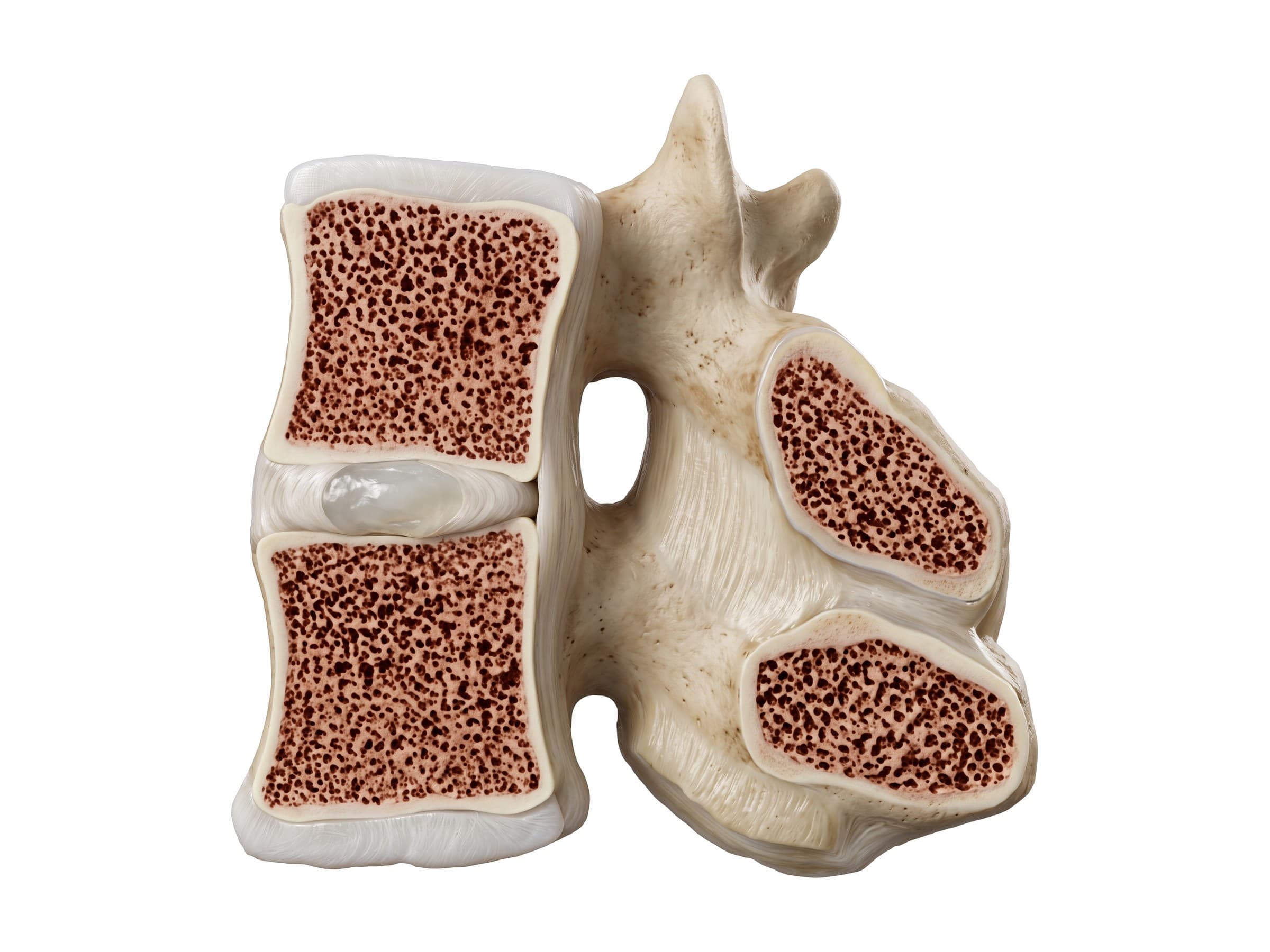Spinal motion segment (midline section): two vertebrae, the disc, intervertebral foramen and ligamentum flavum