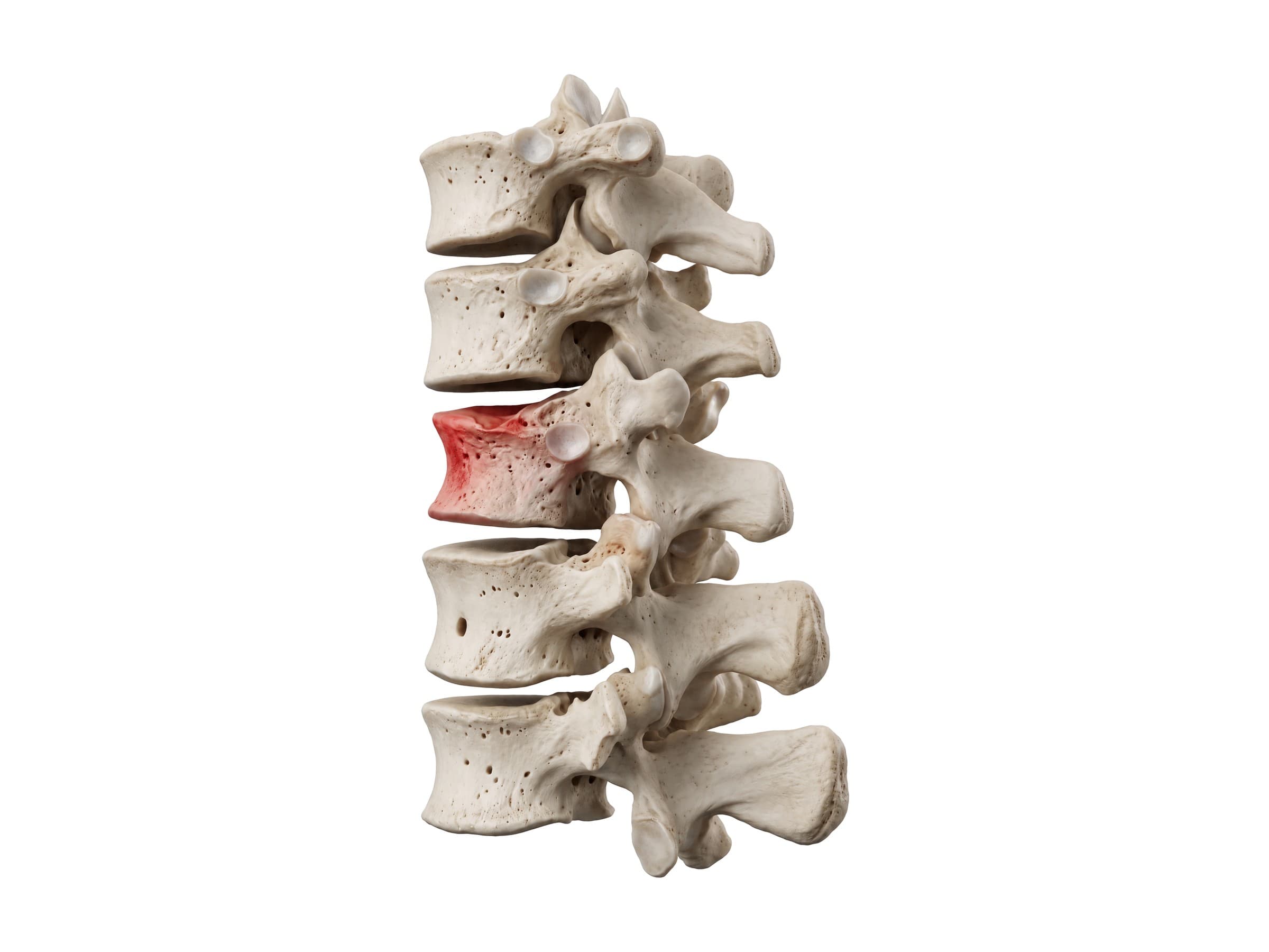 T12 compression fracture (side view): wedge-shaped collapse of the T12 vertebral body in red