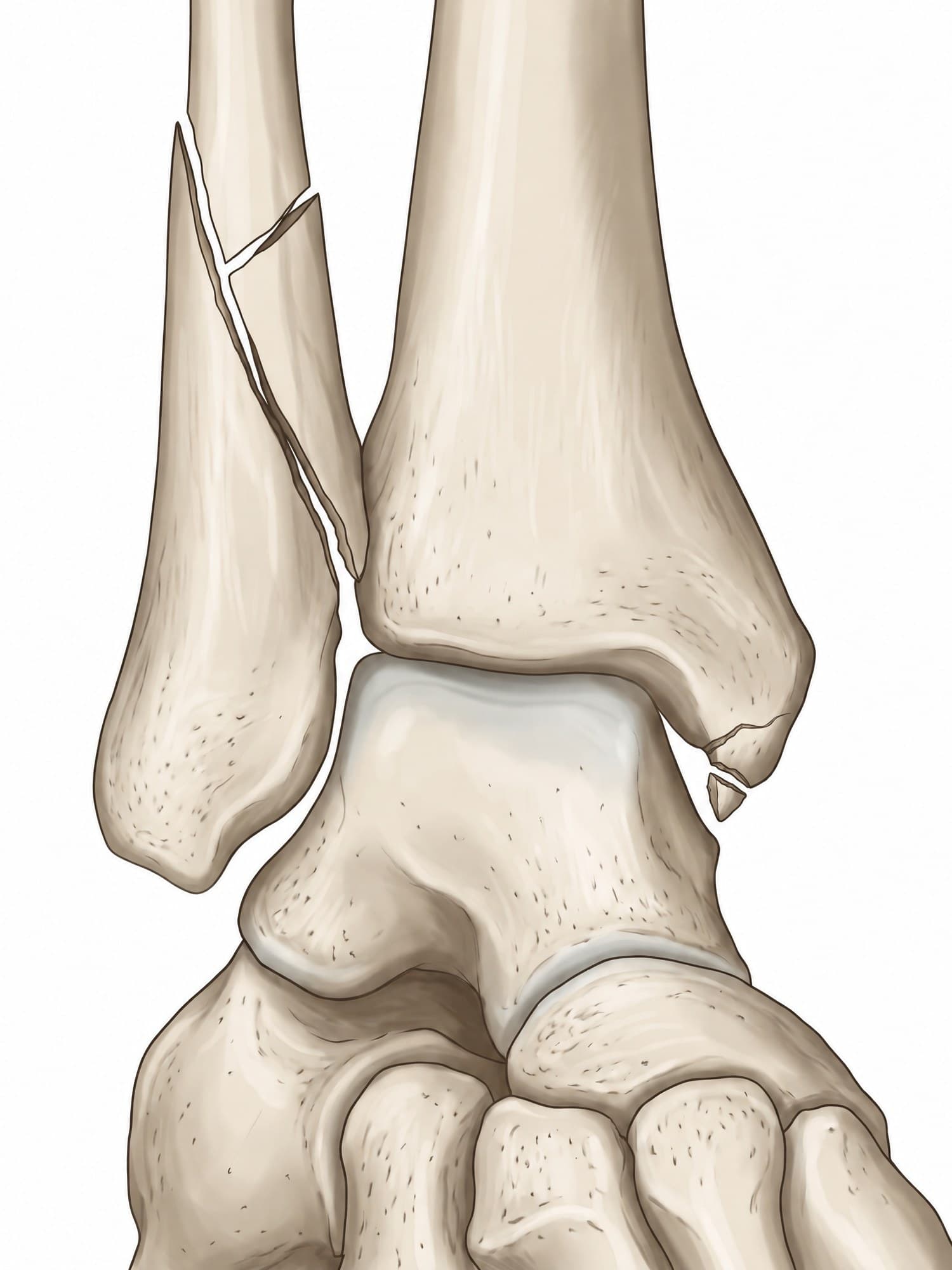 Ankle fracture X-ray and illustration (AP view, right ankle): long spiral fracture of the distal fibula with a small butterfly fragment and a medial malleolus chip fracture