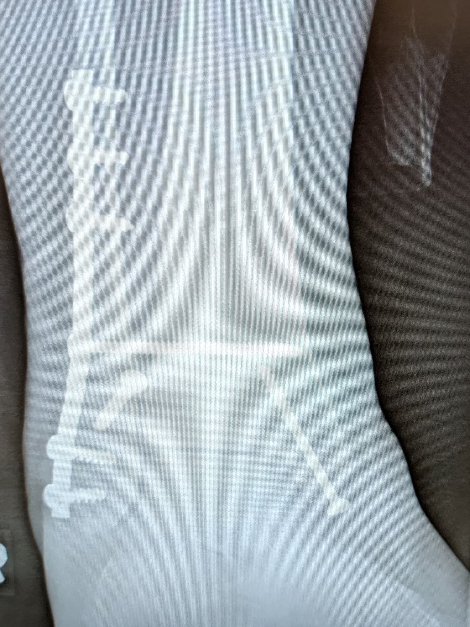 AP X-ray of the right ankle after ORIF with a fibular plate, syndesmosis screw and medial malleolus screw