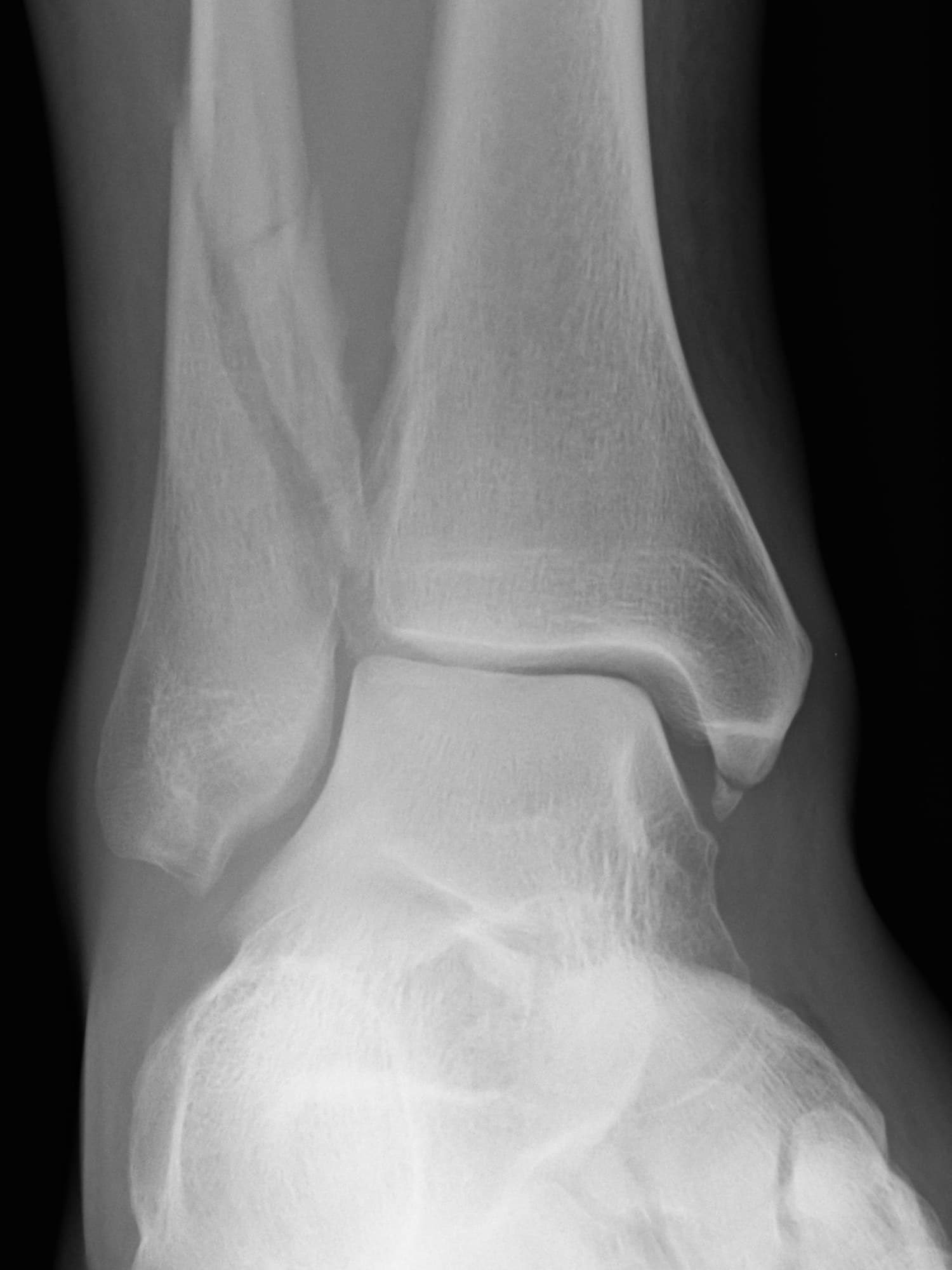 AP X-ray of the right ankle with a long oblique distal fibula fracture and a medial malleolus avulsion