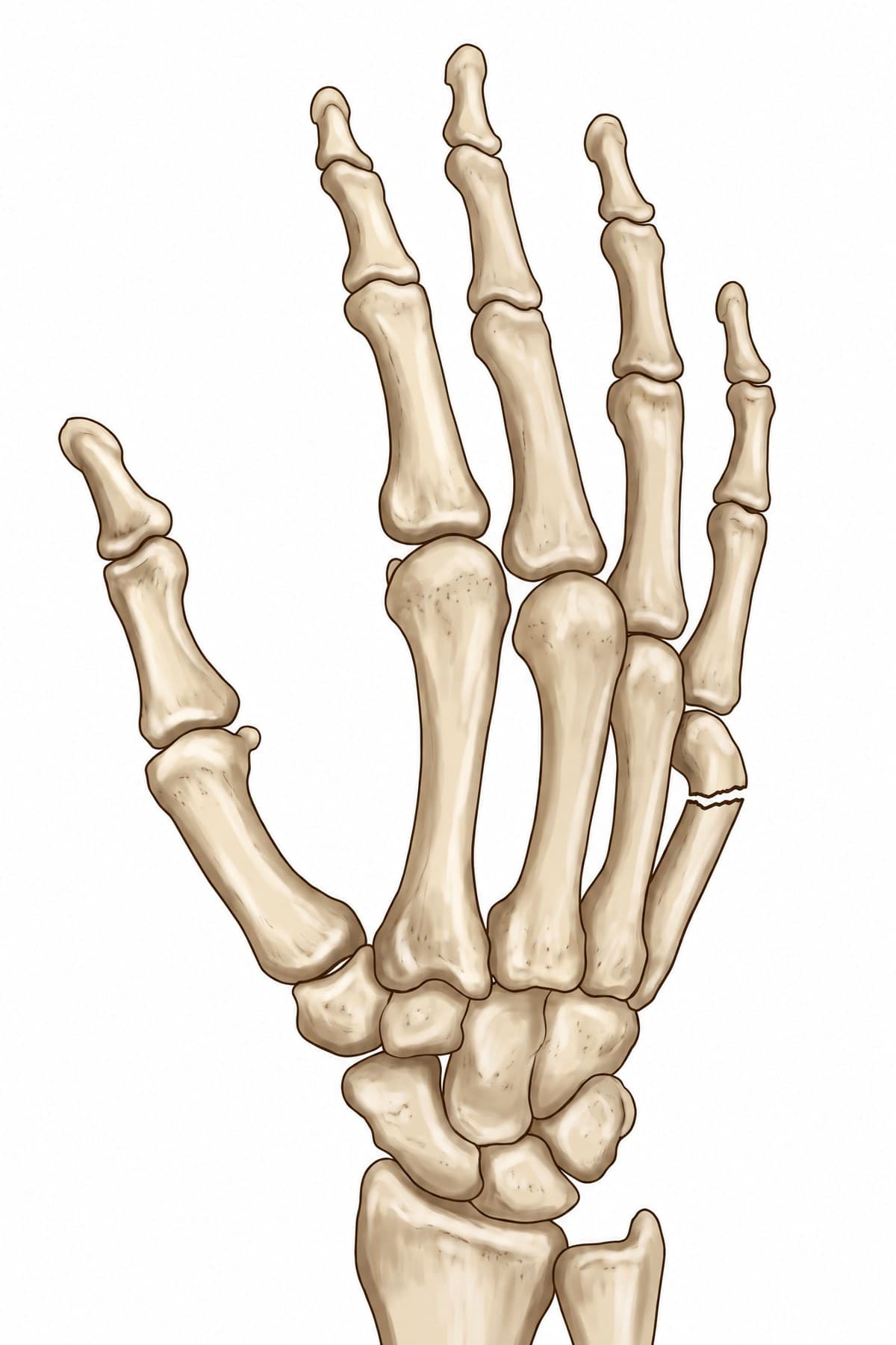 Boxer's fracture X-ray and illustration (PA view, right hand): displaced fracture of the fifth metacarpal neck with the head tilted