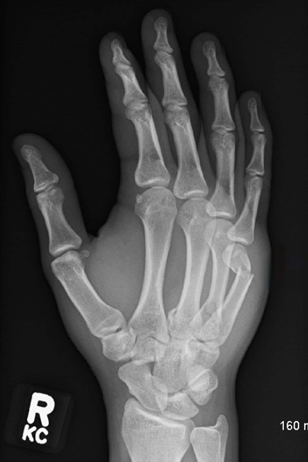 PA X-ray of the right hand with a displaced fifth metacarpal neck fracture