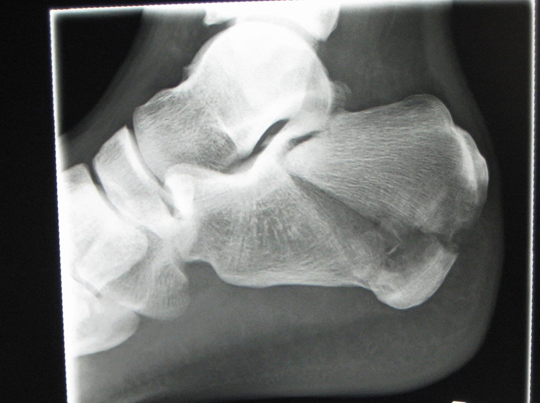 Lateral X-ray of the right hindfoot with a displaced tongue-type calcaneus fracture after a fall from a roof