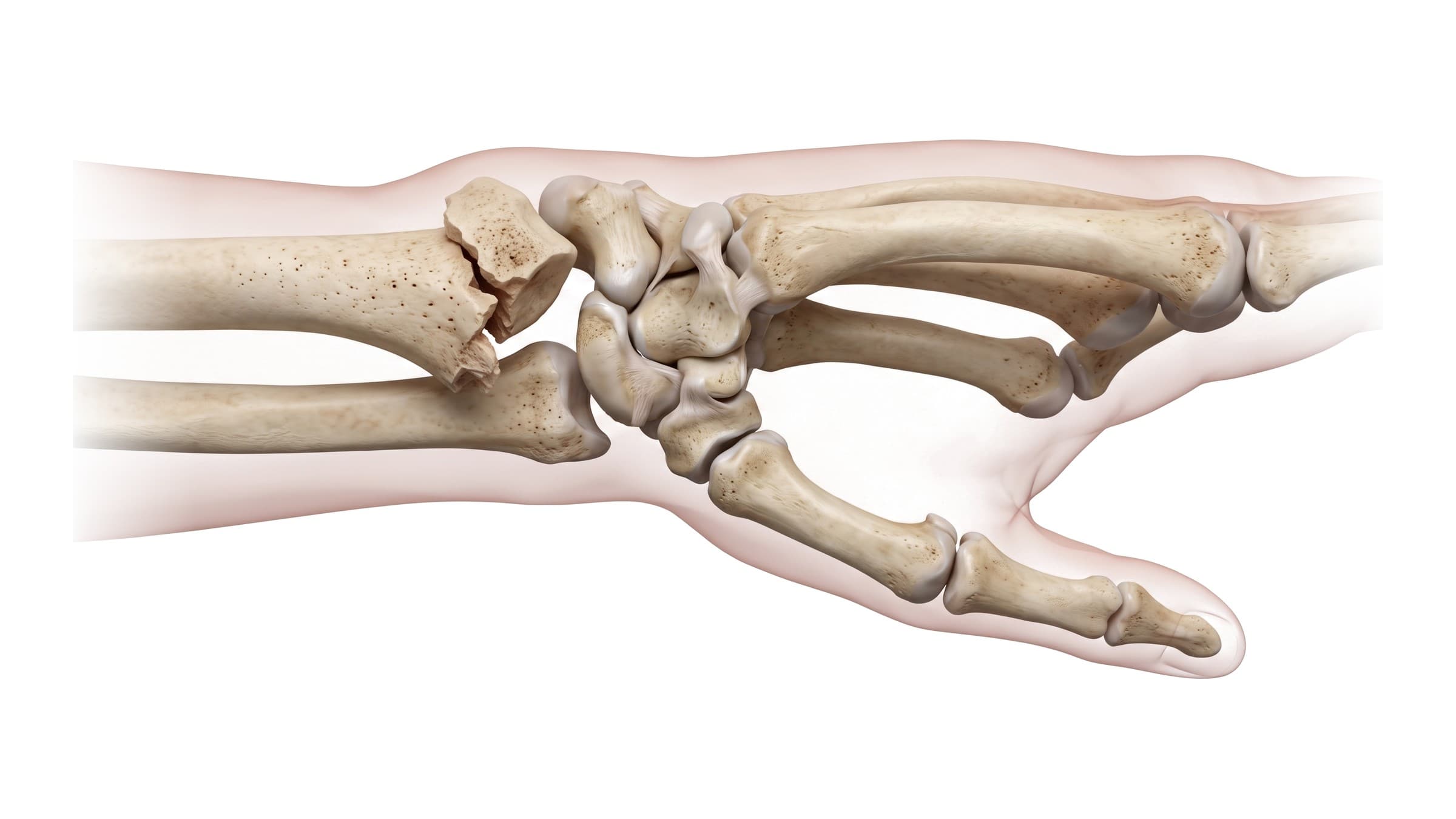 Colles fracture dinner fork deformity (side view): distal radius fragment and hand shifted toward the back of the wrist